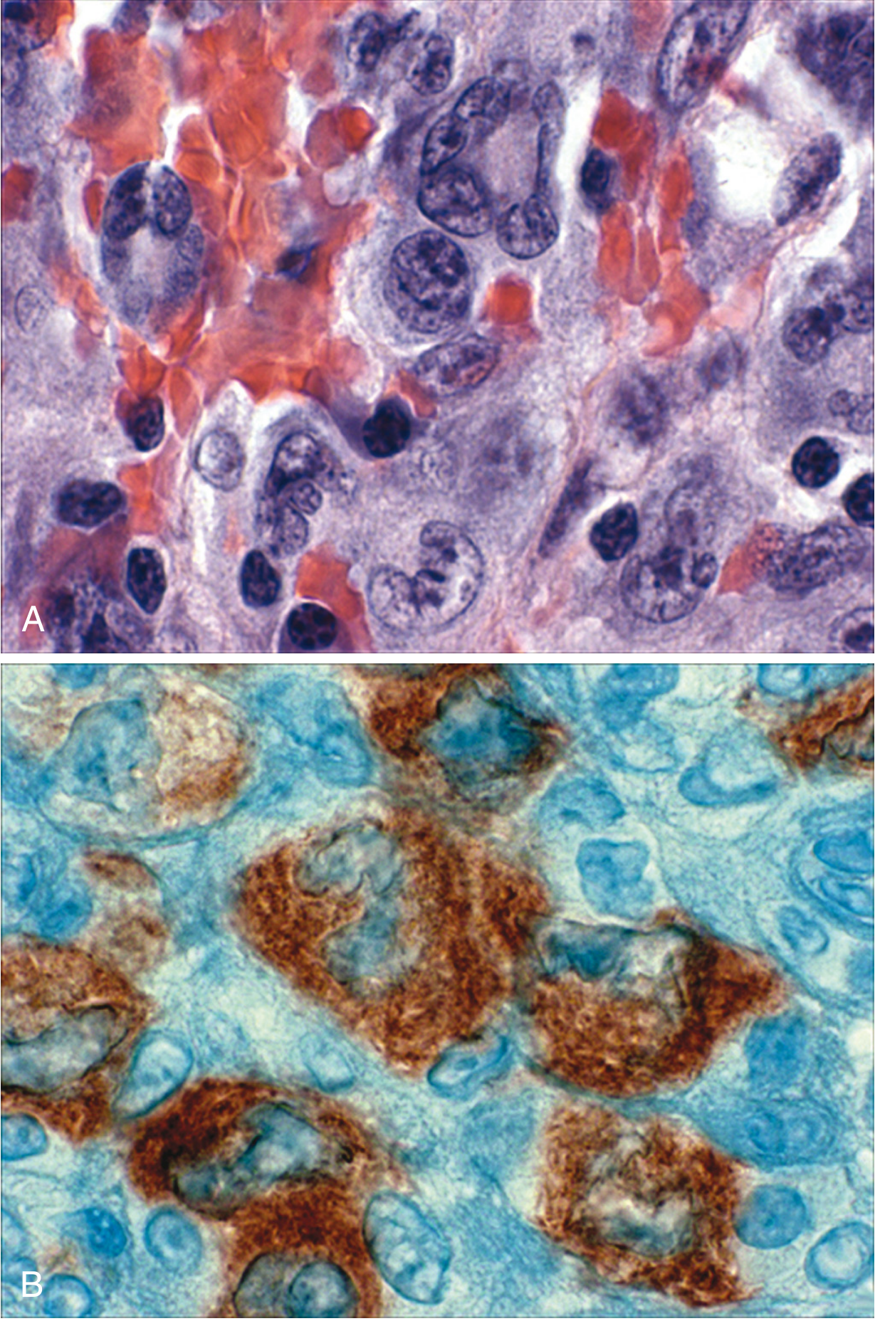 ALCL: (A) Hallmark cells with horseshoe nuclei and abundant cytoplasm. (B) IHC showing ALK fusion protein (brown staining)