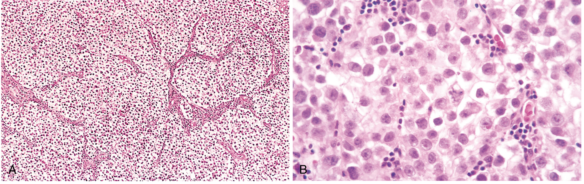Seminoma microscopy - low and high power
