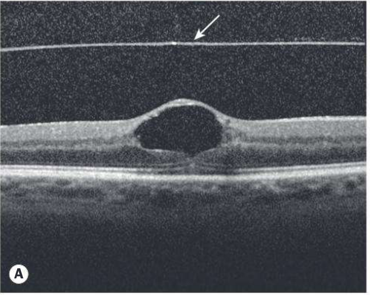 Kanski OCT lamellar hole - hyaloid detached