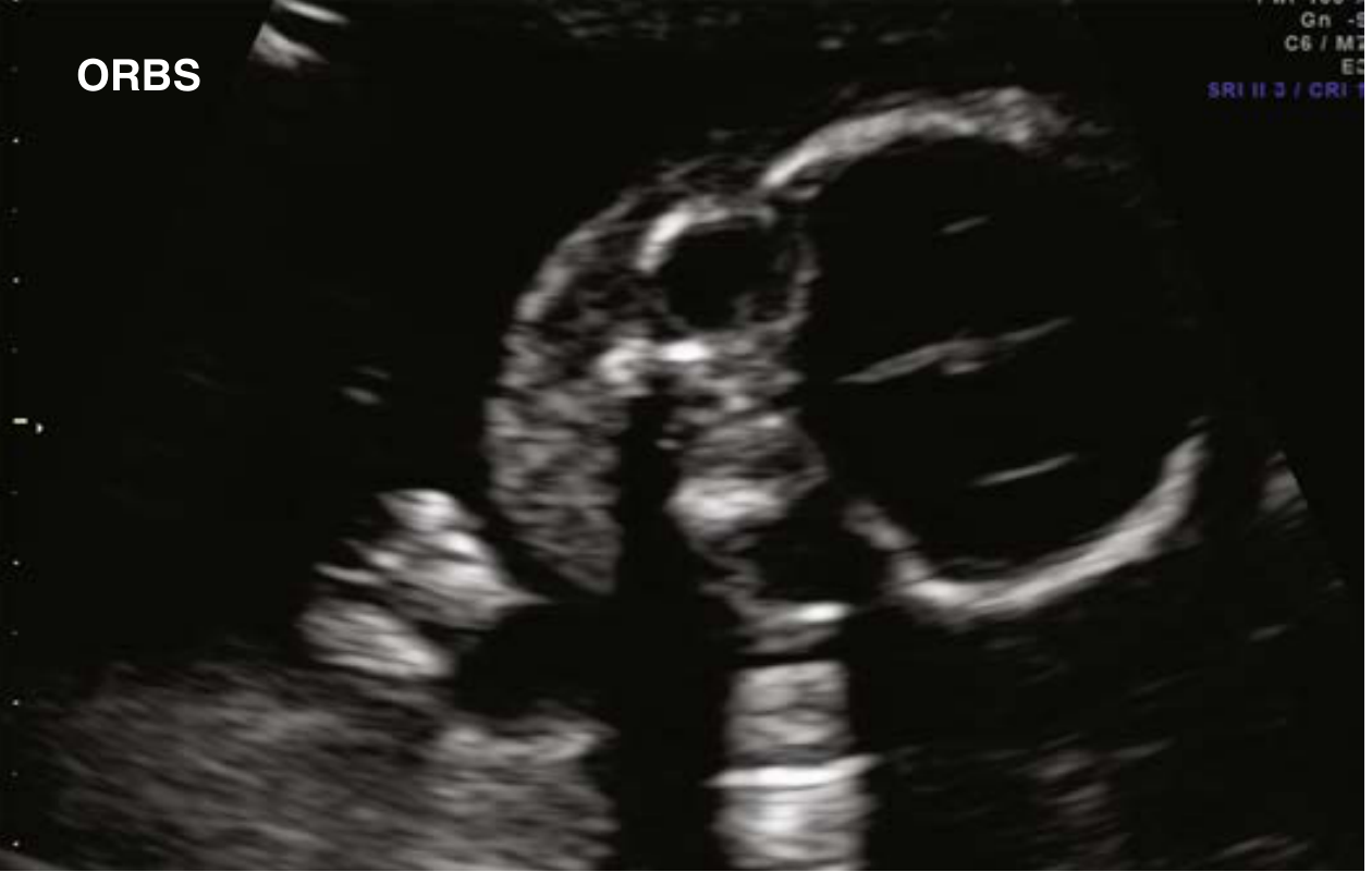 Fetal orbits on ultrasound - transverse facial plane