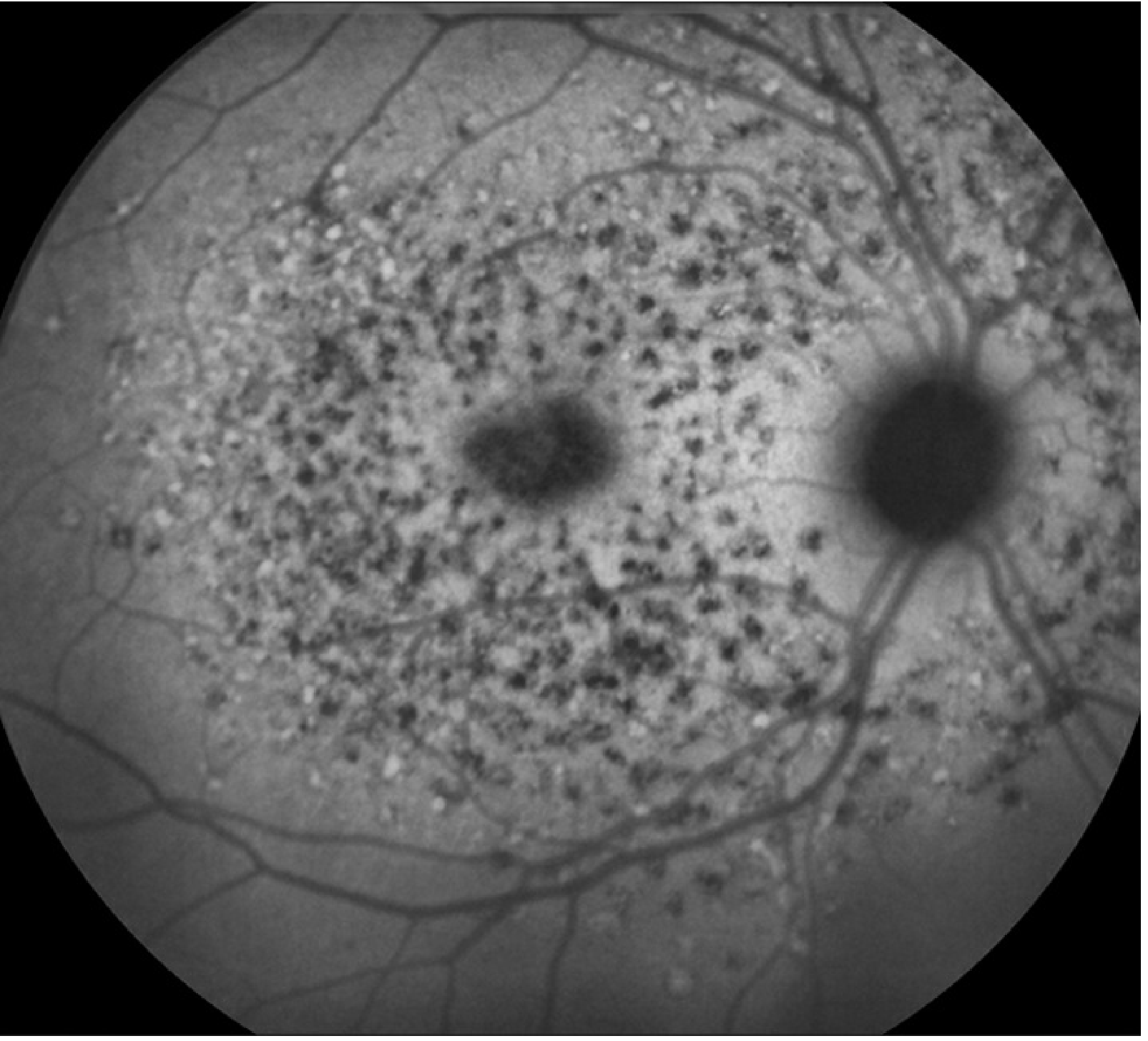 Fundus autofluorescence in Stargardt disease showing scattered hyperautofluorescent flecks with macular hypoautofluorescence