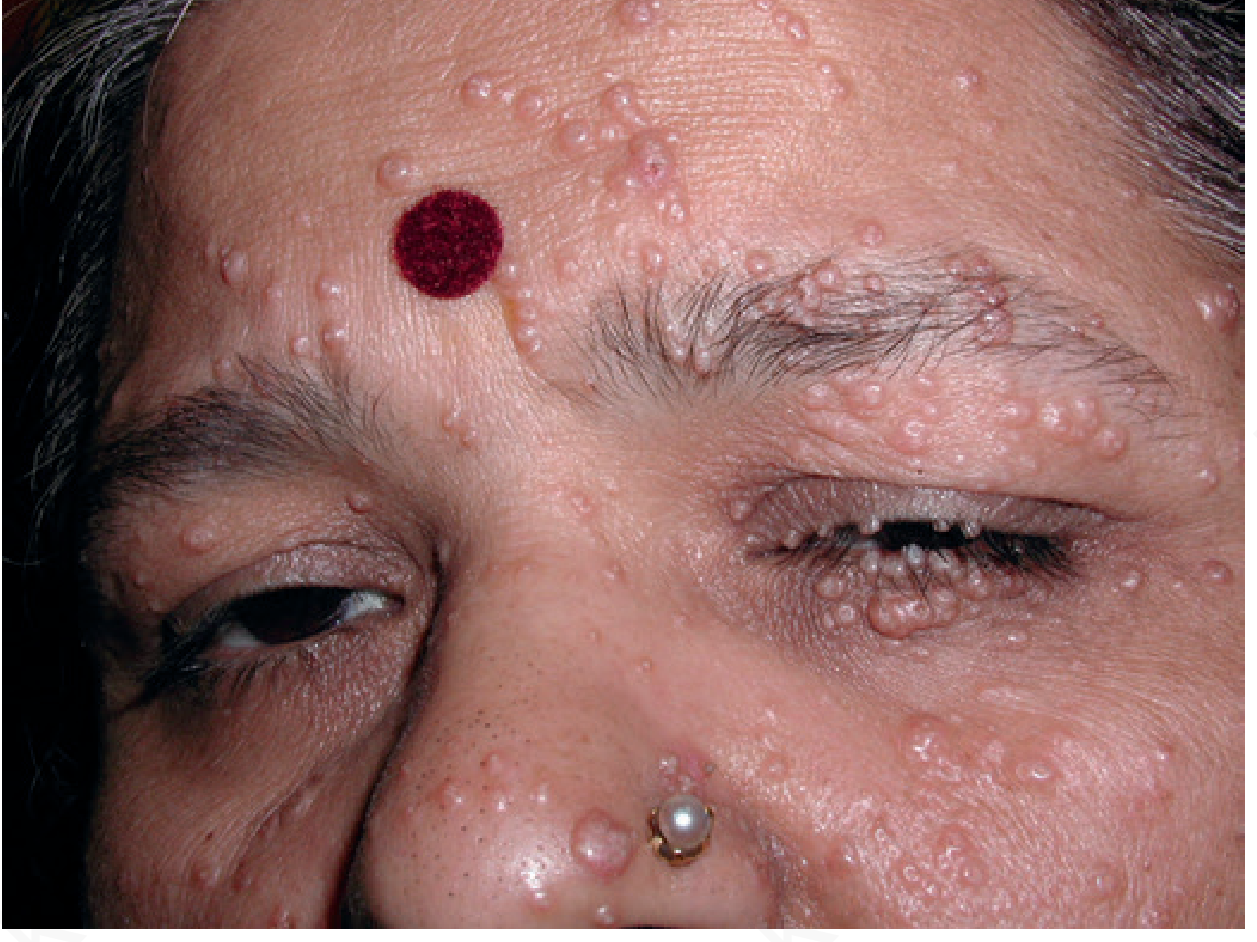 Extensive molluscum contagiosum in immunosuppressed patient - hundreds of dome-shaped papules covering the face