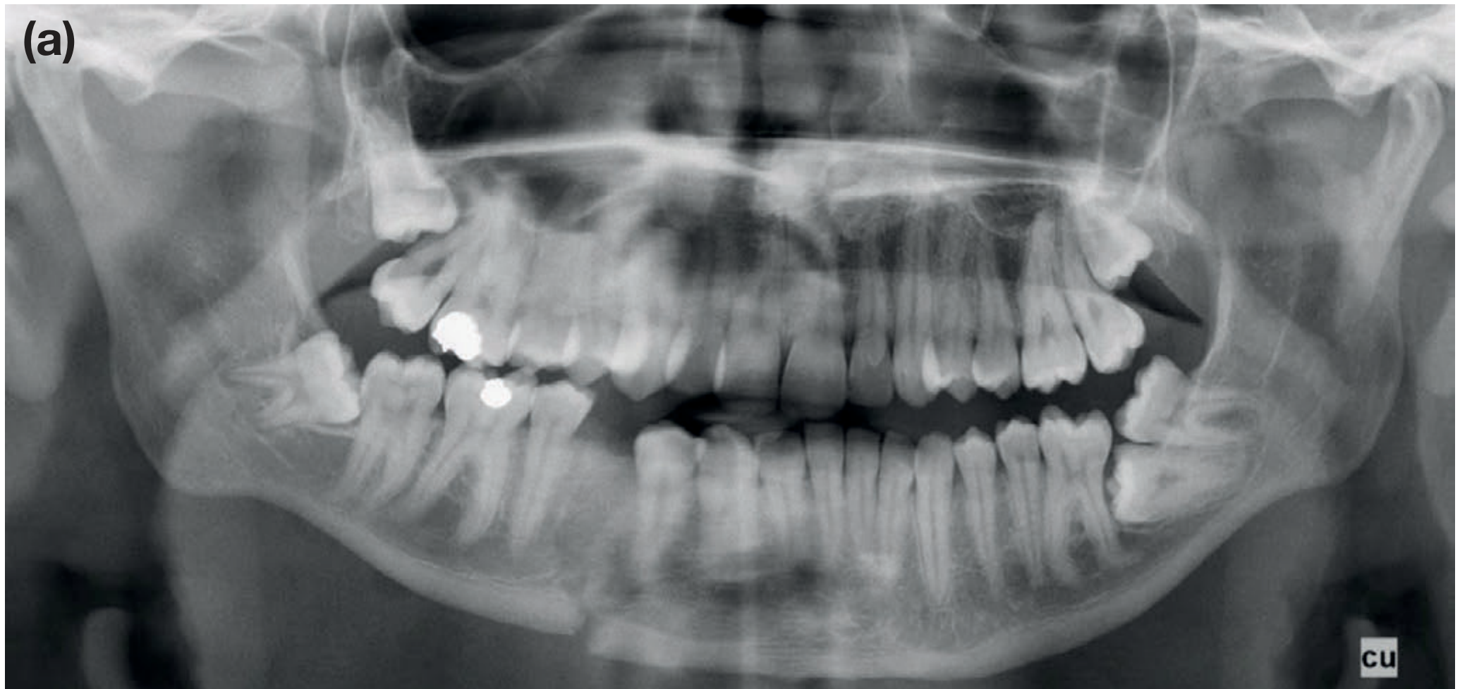 OPT showing right mandibular body and left condylar fracture