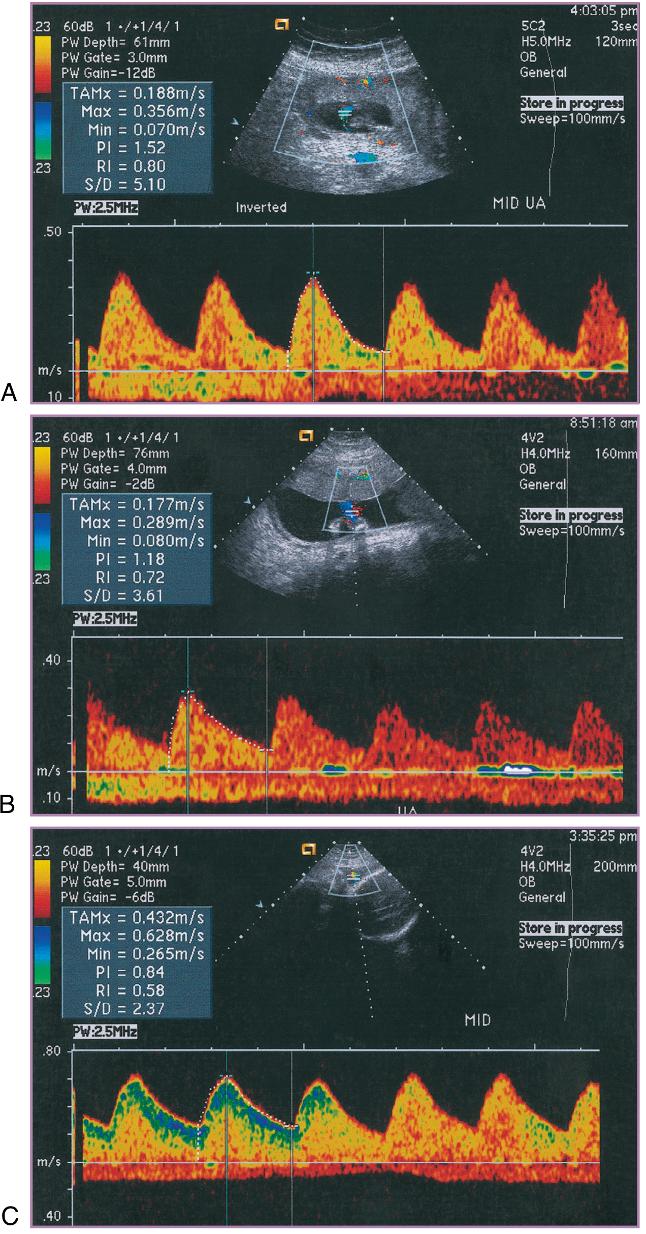 Evolution of umbilical artery Doppler waveforms: (A) first trimester high resistance, (B) mid-pregnancy normal diastolic flow, (C) third trimester normal low resistance pattern