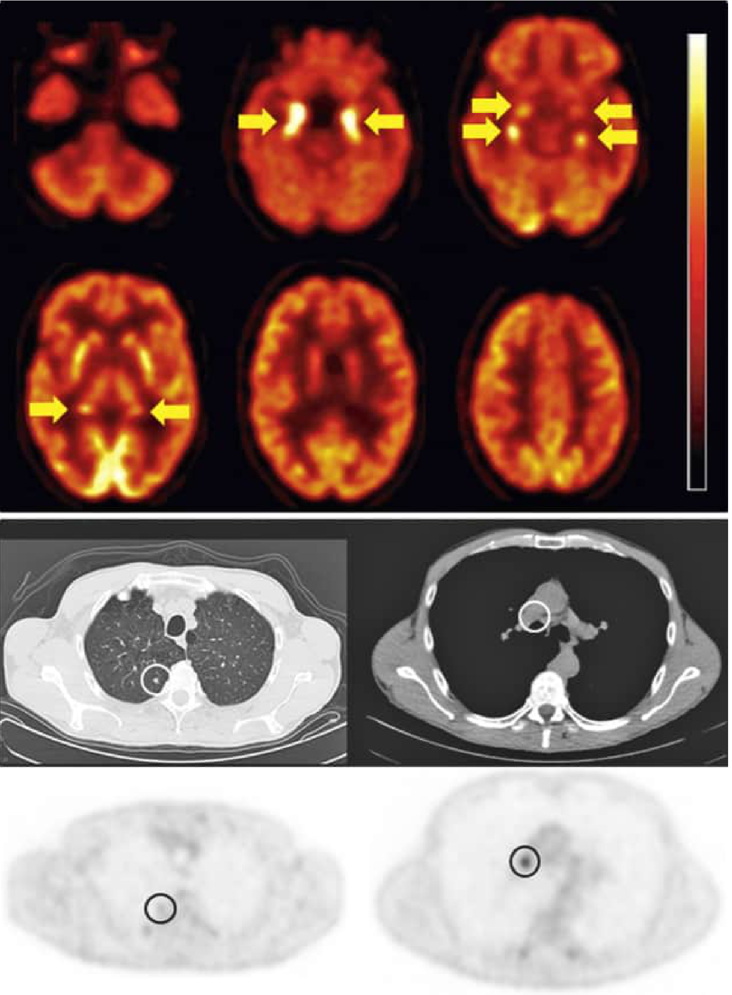 Paraneoplastic limbic encephalitis FDG PET showing bilateral mesiotemporal hypermetabolism with whole-body PET CT showing primary lung tumor