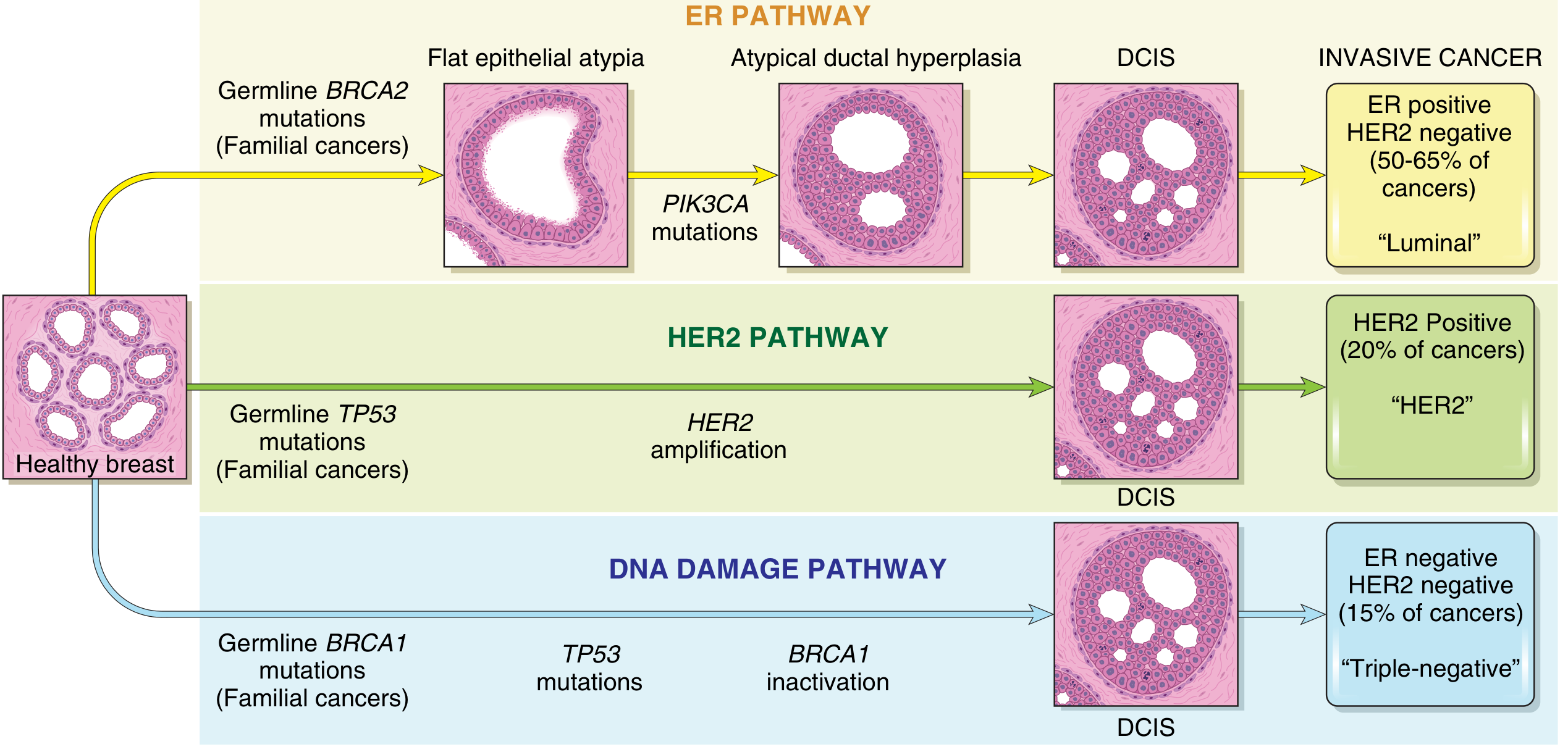 Major pathways of ductal breast cancer development - ER pathway (BRCA2/PIK3CA → Luminal), HER2 pathway (TP53/HER2 amplification), DNA Damage pathway (BRCA1/TP53 → Triple-negative)