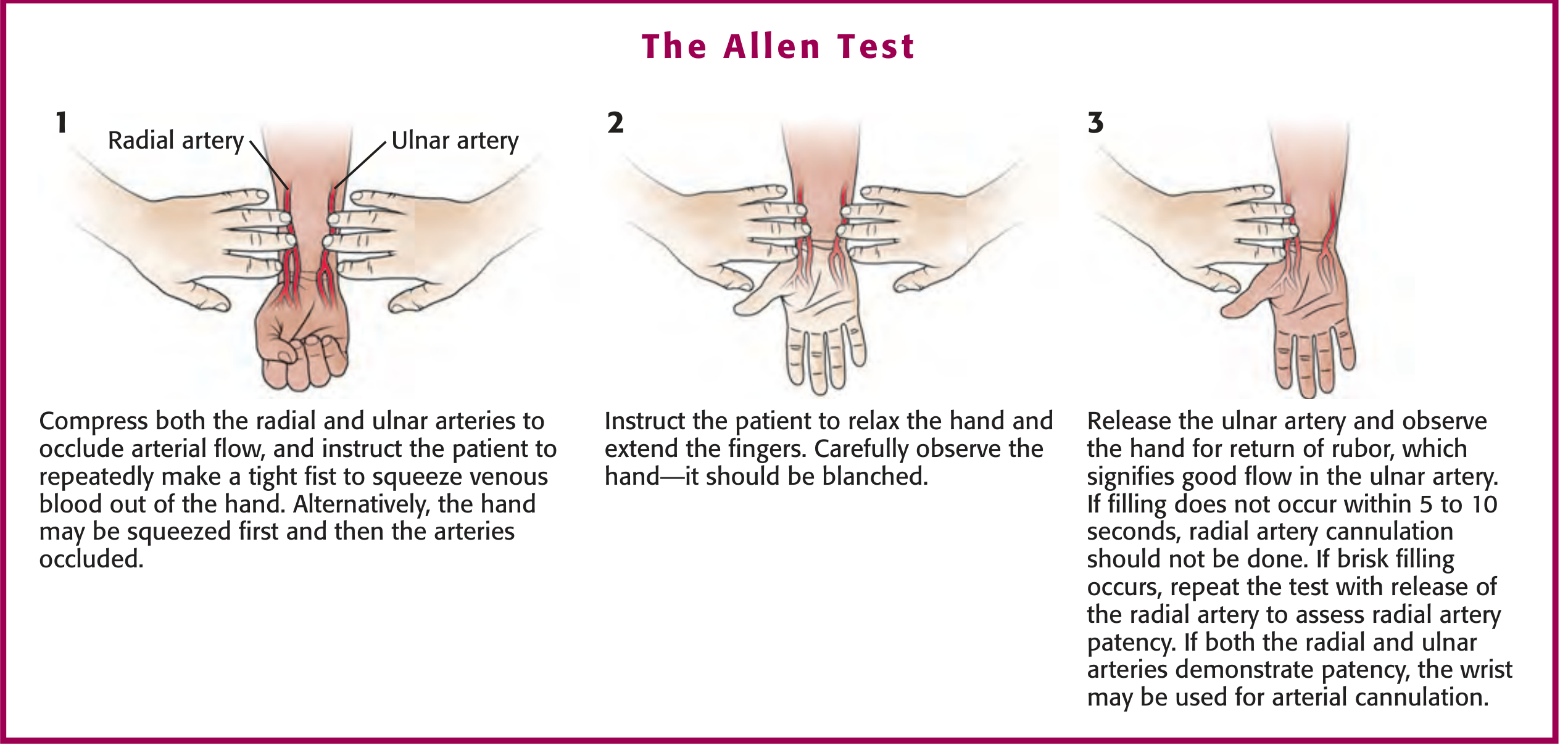 The Allen Test - 3-step diagram