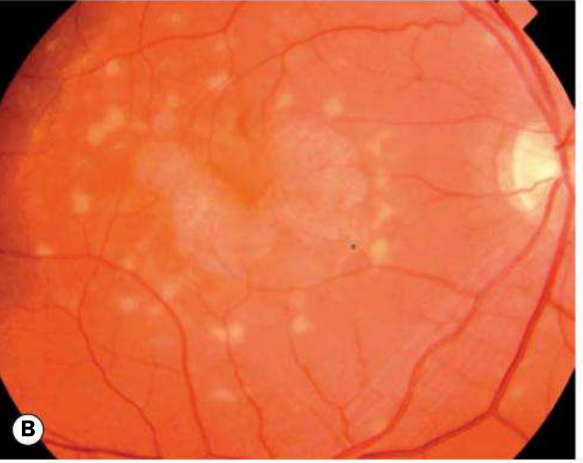 Fundus photo showing yellow-white pisciform flecks scattered across the posterior pole in Stargardt disease