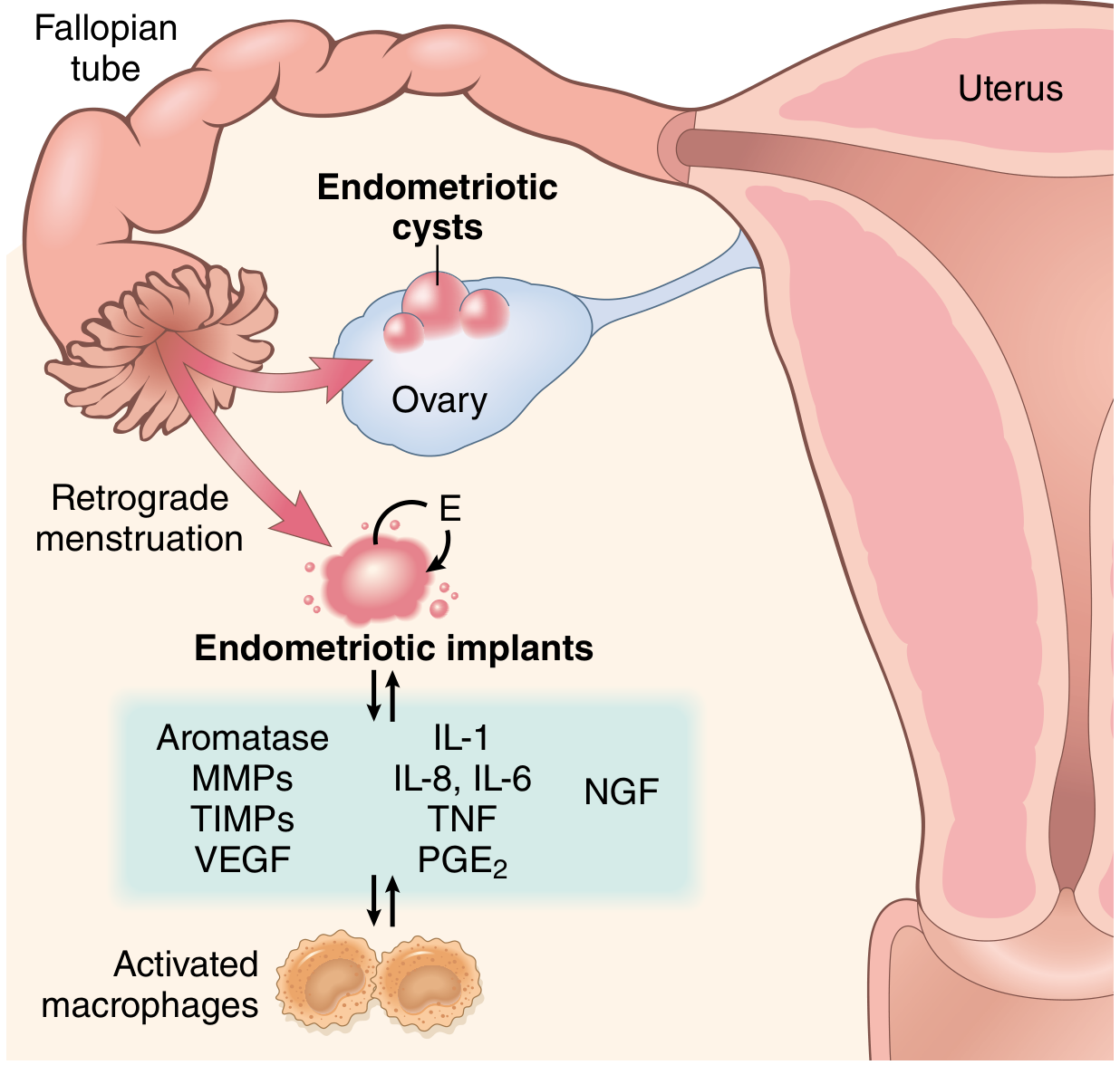 Endometriosis pathogenesis - retrograde menstruation, implants, and inflammatory mediators