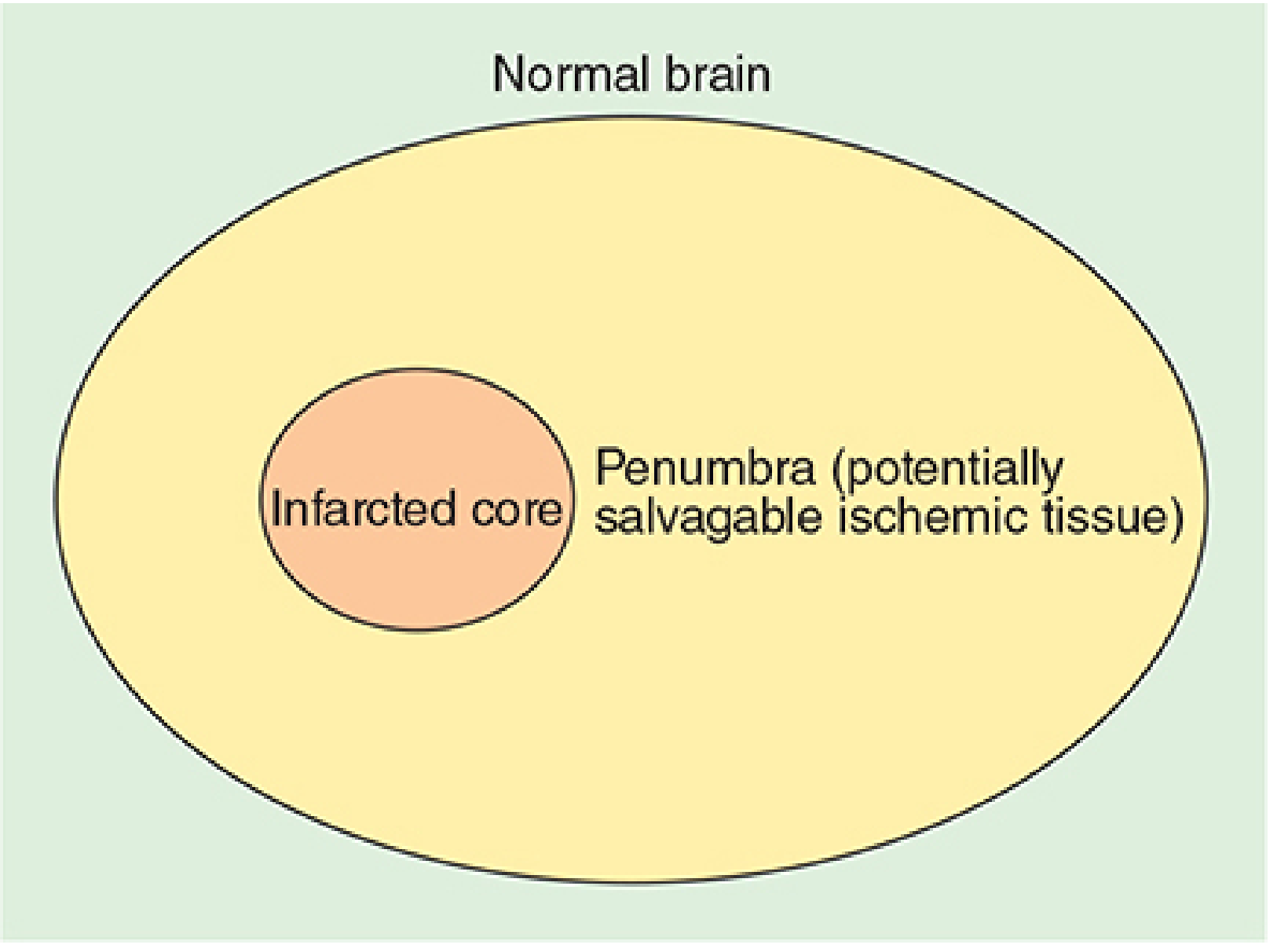 Ischemic stroke anatomy - infarcted core surrounded by penumbra of potentially salvageable ischemic tissue