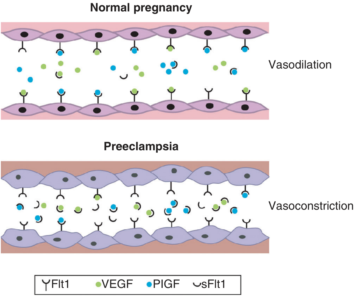 sFlt-1 mechanism of endothelial dysfunction in pre-eclampsia vs normal pregnancy
