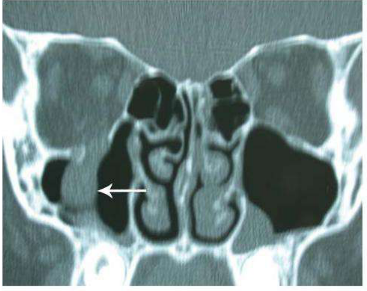 CT scan (coronal) showing right orbital floor blow-out fracture with the "teardrop sign" - soft tissue prolapsing into maxillary antrum (white arrow)