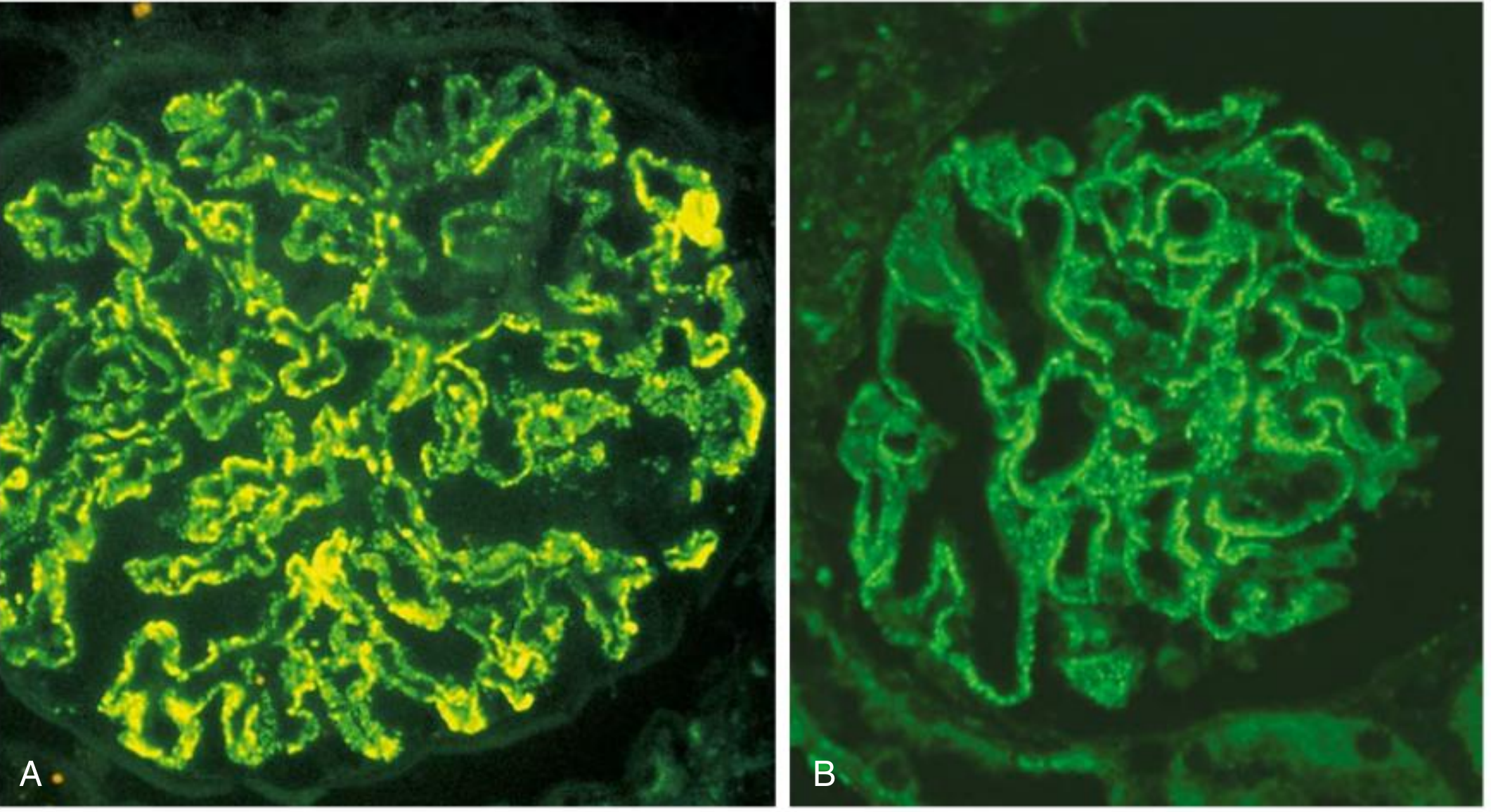 IF in Membranous Nephropathy: (A) finely granular IgG along capillary walls; (B) PLA2R staining in same distribution