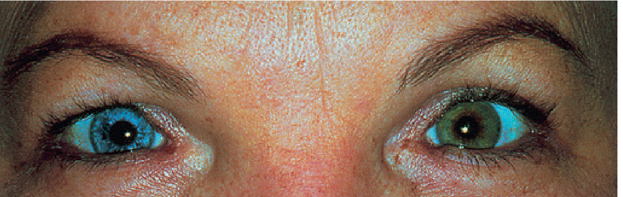 Heterochromia iridis in Waardenburg syndrome - one blue eye and one green eye