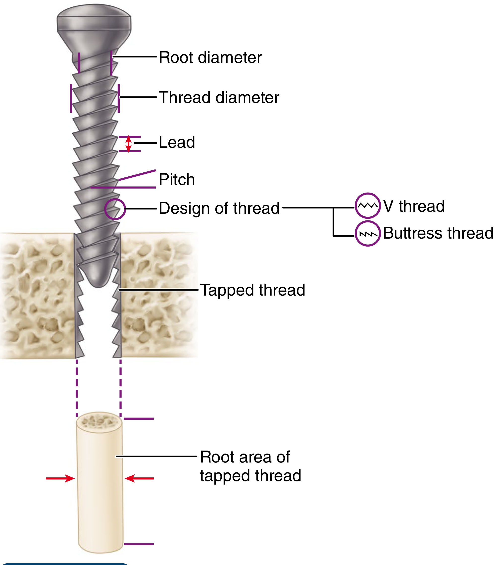 Design parameters of an orthopaedic bone screw showing root diameter, thread diameter, lead, pitch, thread design, tapped thread, and root area