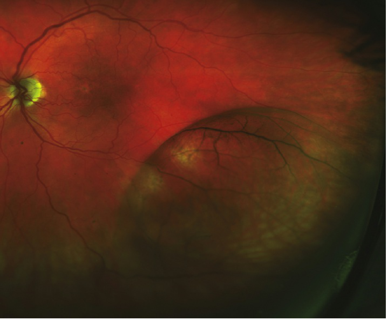 Age-related degenerative retinoschisis — fundus photo showing dome-shaped inferotemporal elevation