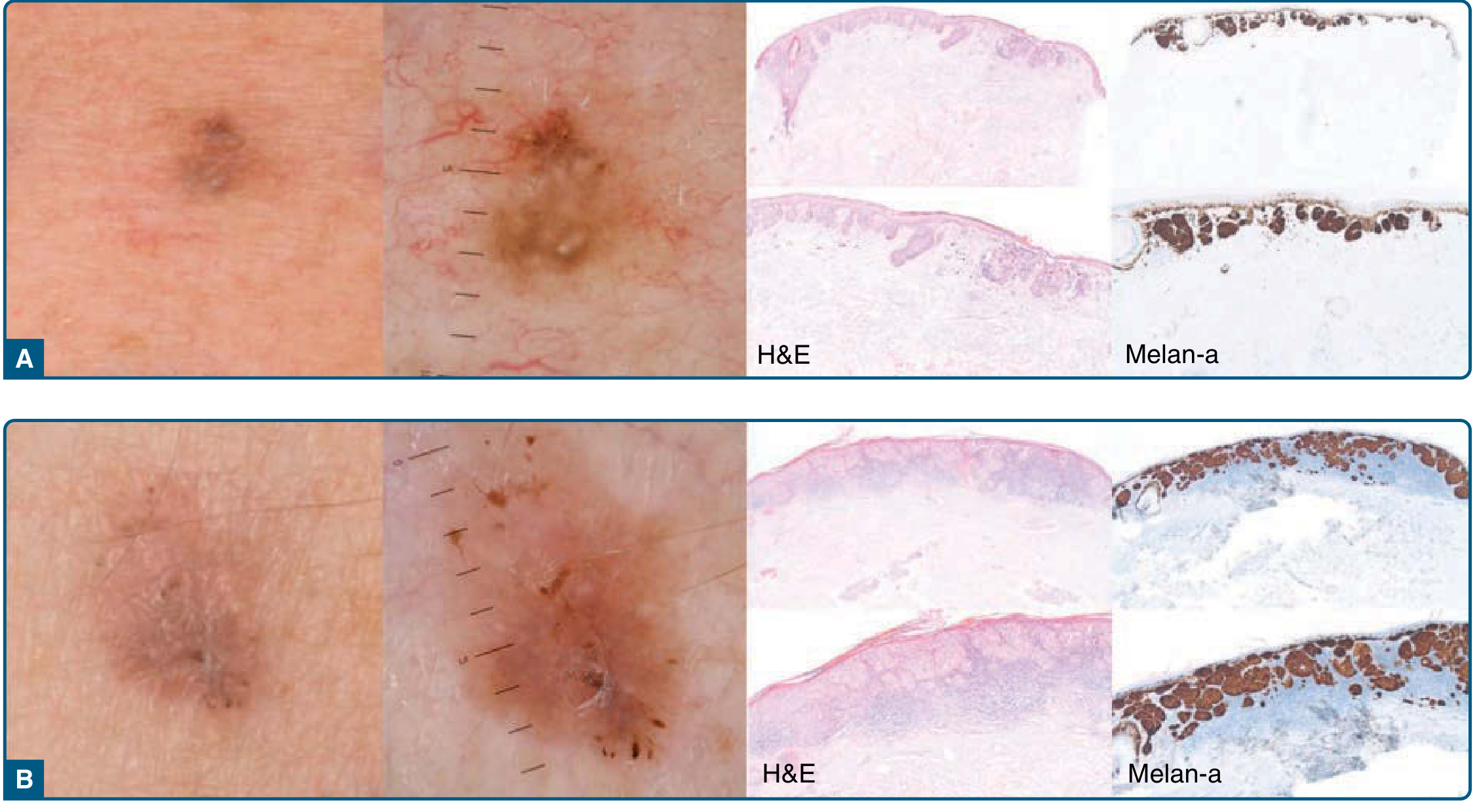 Superficial spreading melanoma clinical dermoscopy histology
