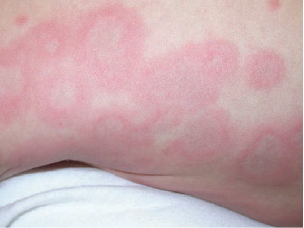 Urticaria - confluent erythematous wheals on skin