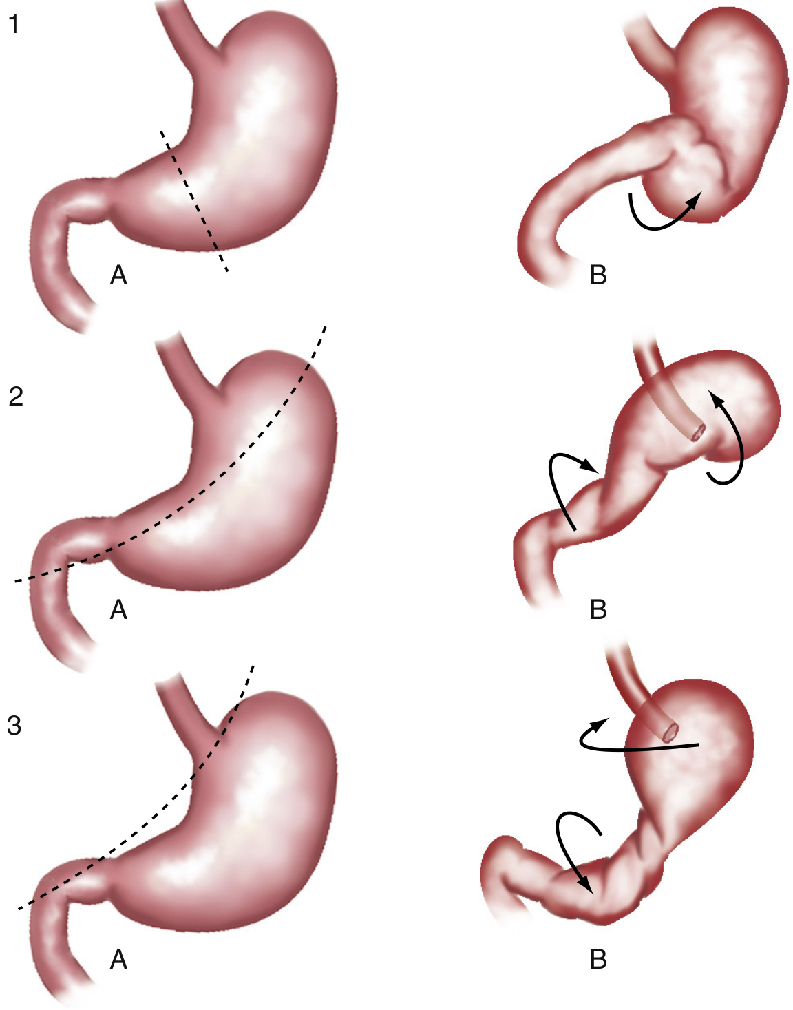 Detailed 3D illustrations of all axis positions and resulting rotations in gastric volvulus - rows 1 (mesenteroaxial) and 2-3 (organoaxial)