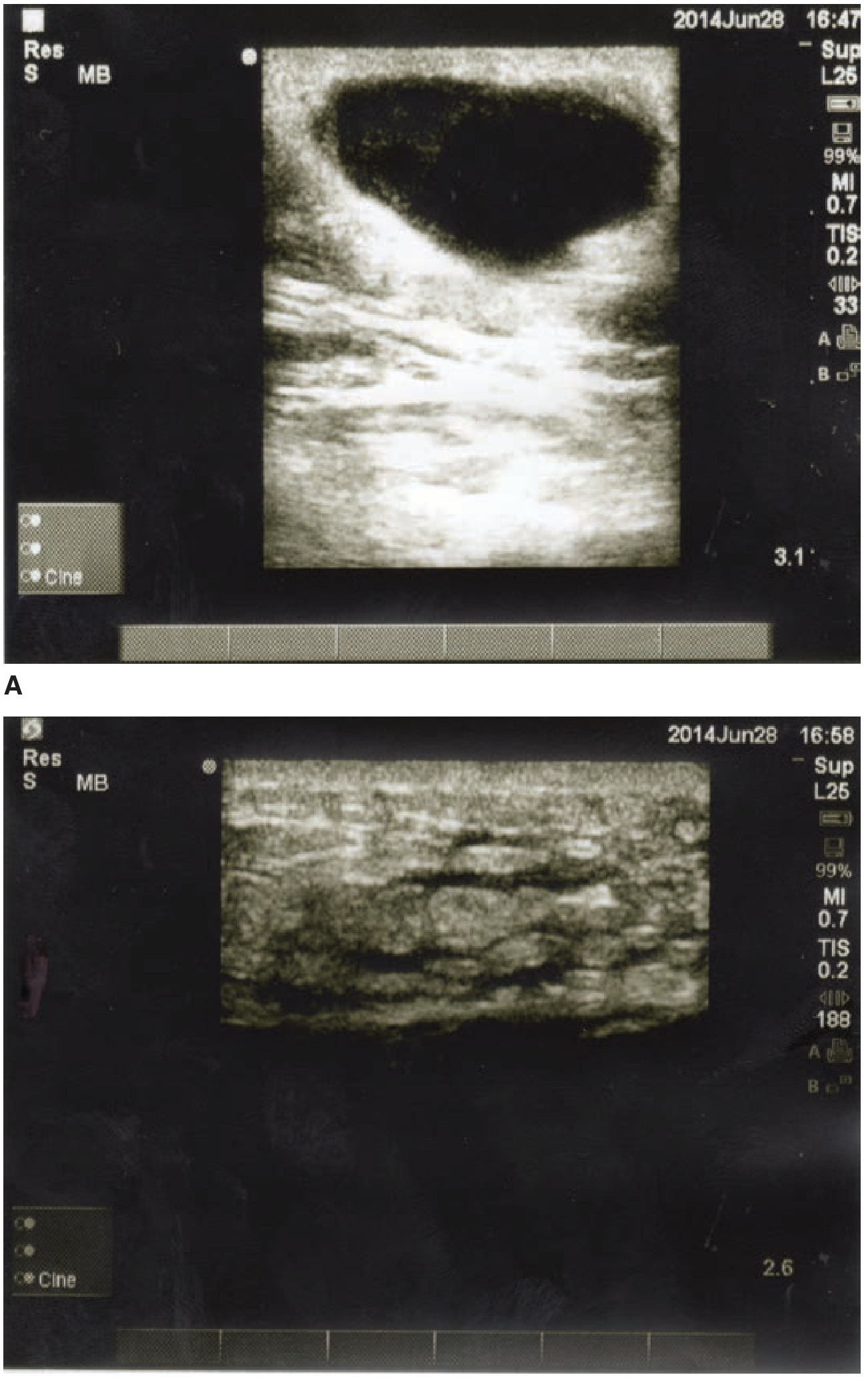 Ultrasound: abscess vs cellulitis - abscess shows anechoic cavity; cellulitis shows cobblestone pattern