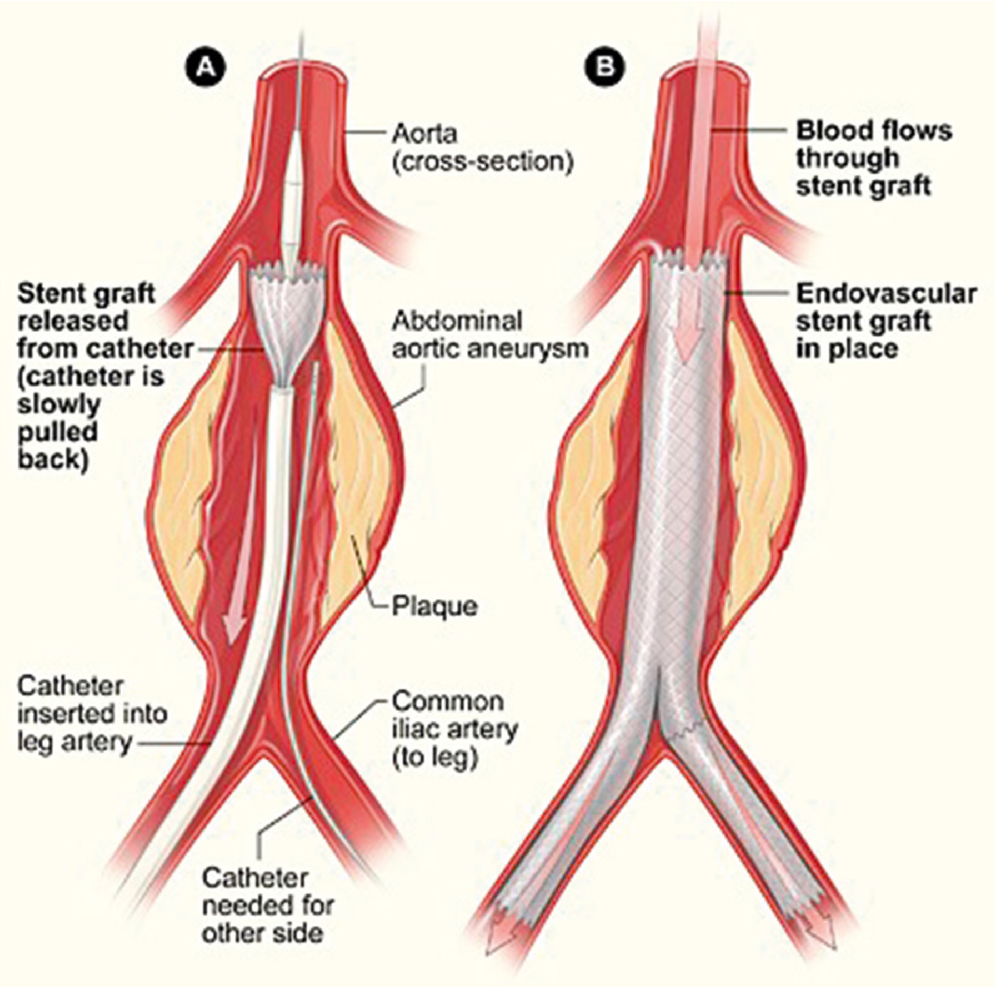 EVAR stent graft deployment - showing catheter insertion into leg artery and stent graft release within the abdominal aortic aneurysm