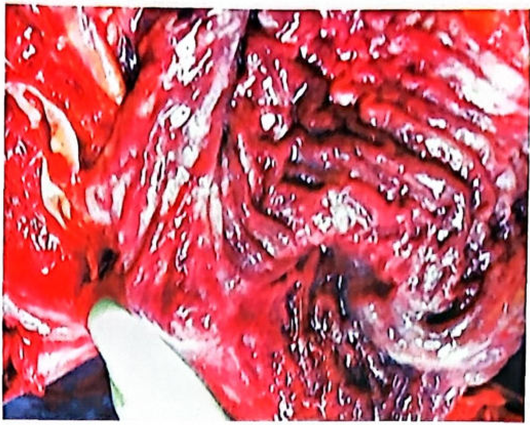 Postmortem appearance of stomach in aluminium phosphide poisoning - showing severe hemorrhagic gastric mucosal damage