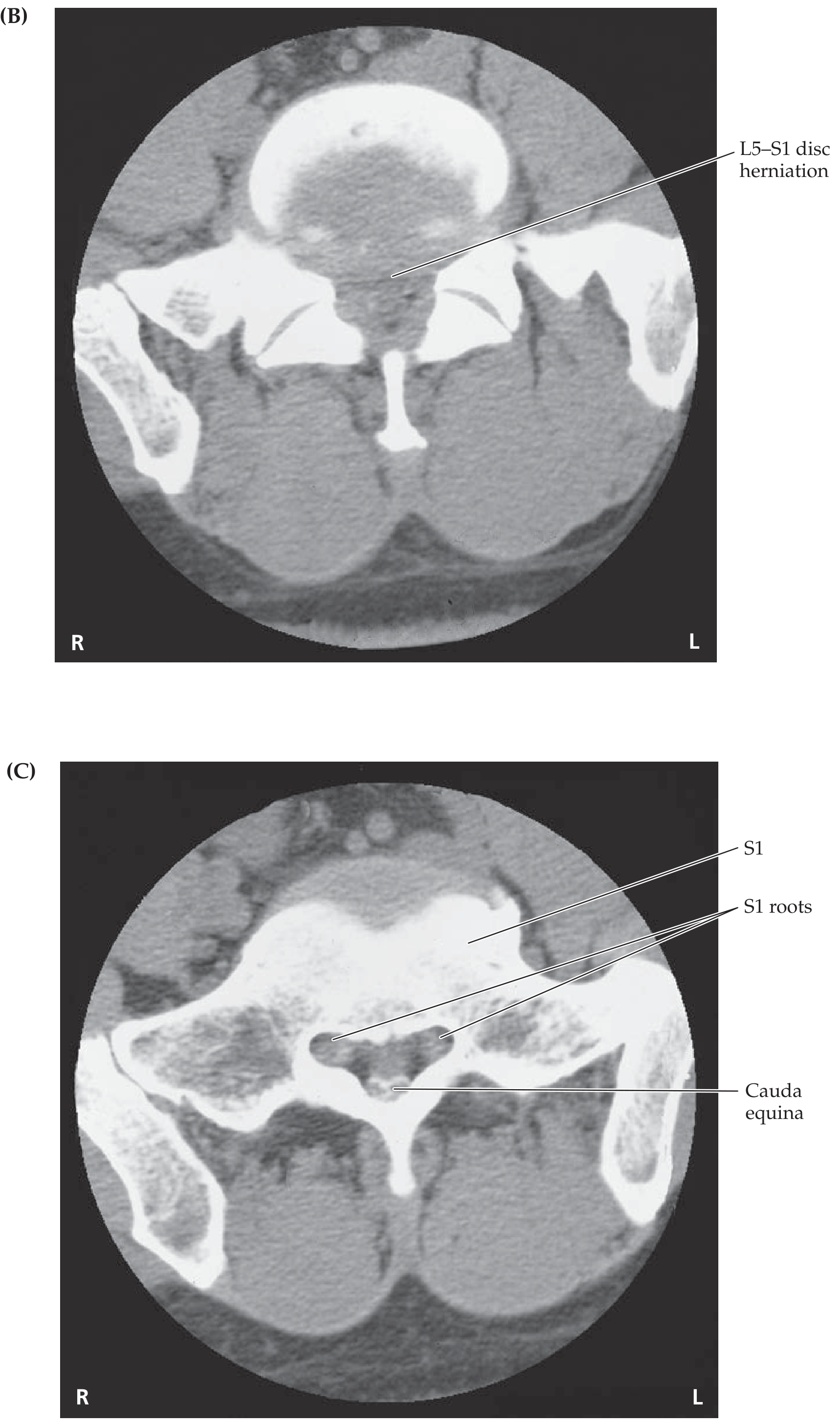 L5-S1 massive herniation and S1 roots