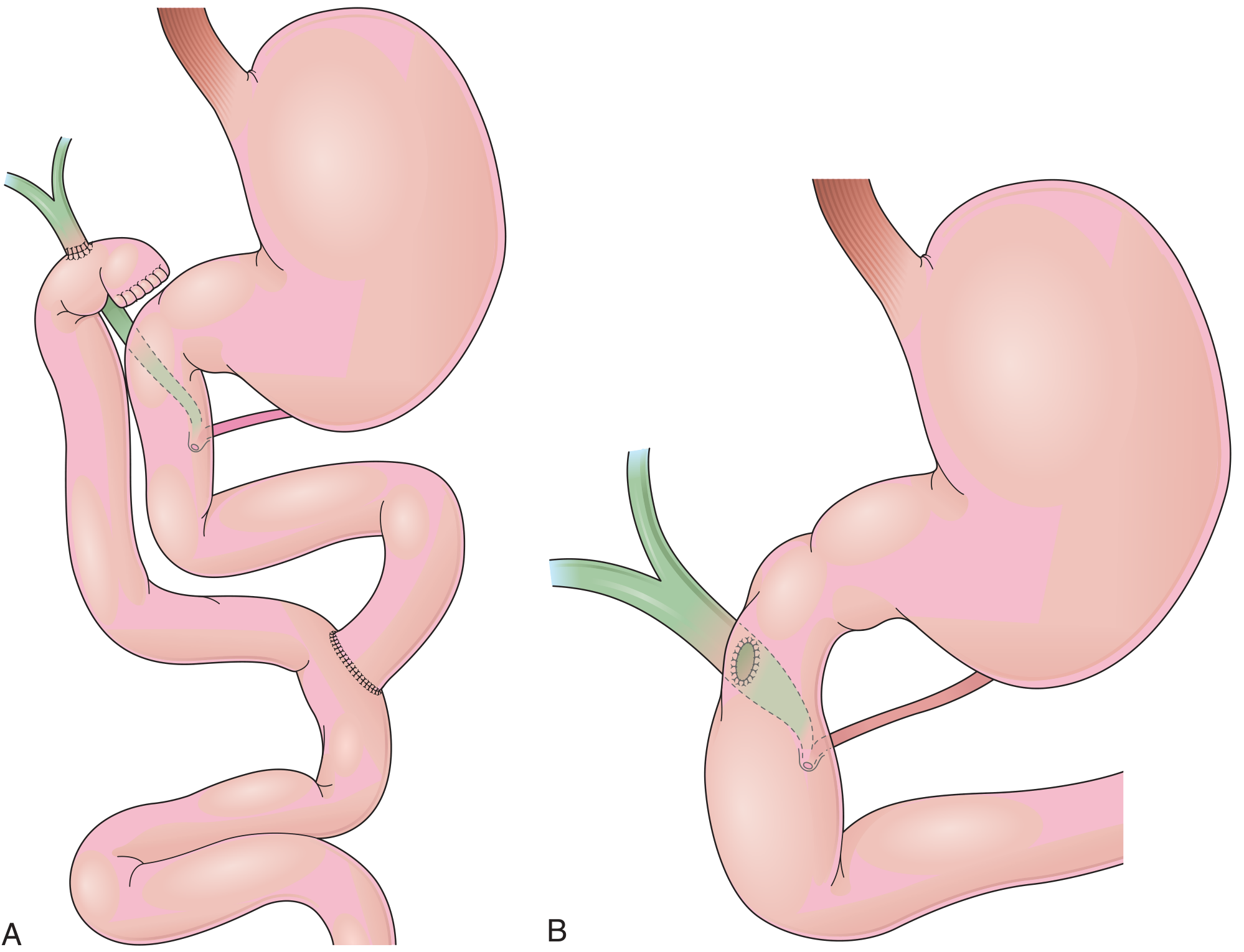 Bilioenteric anastomoses comparison