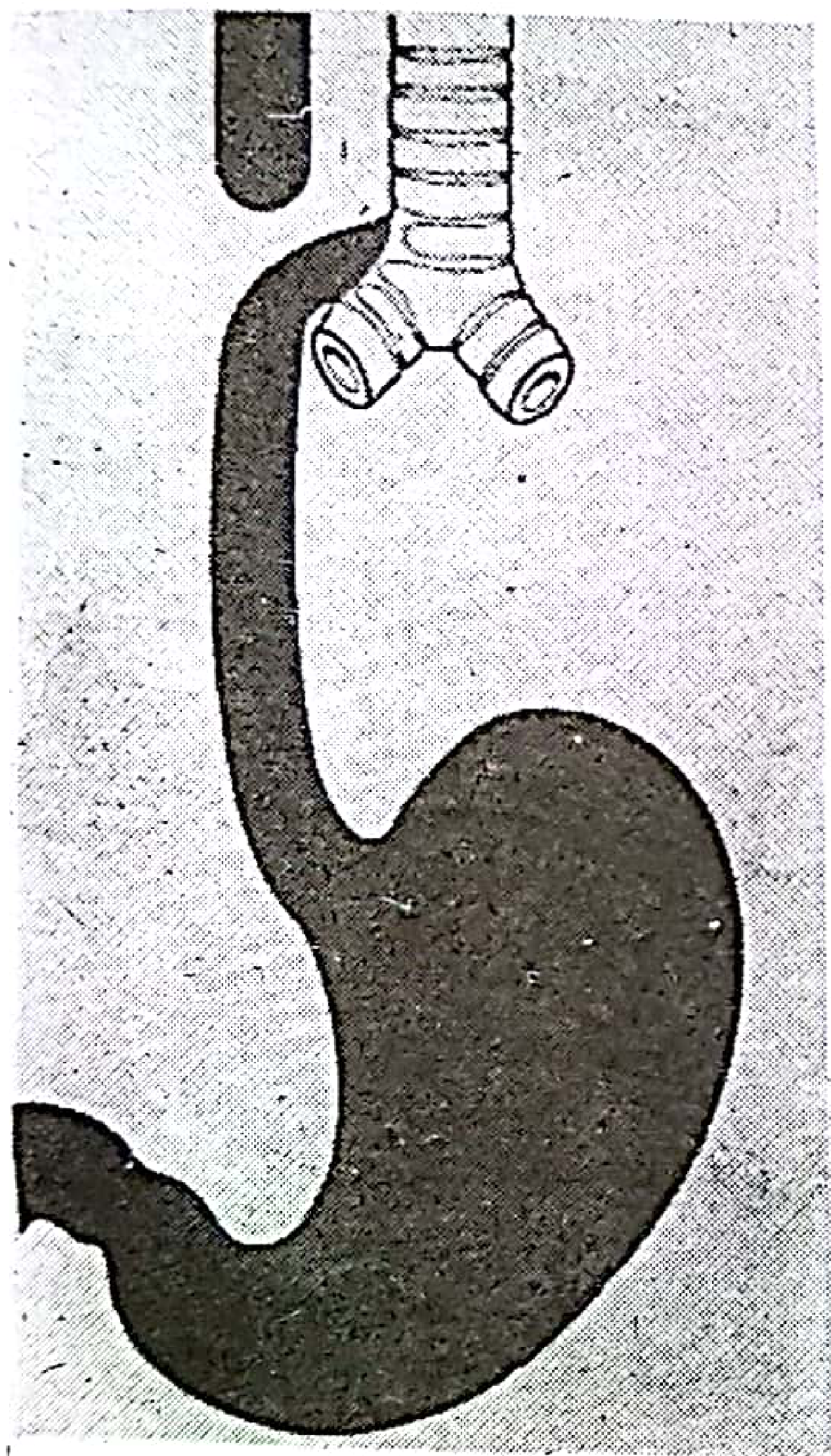 Common esophageal atresia with distal tracheoesophageal fistula