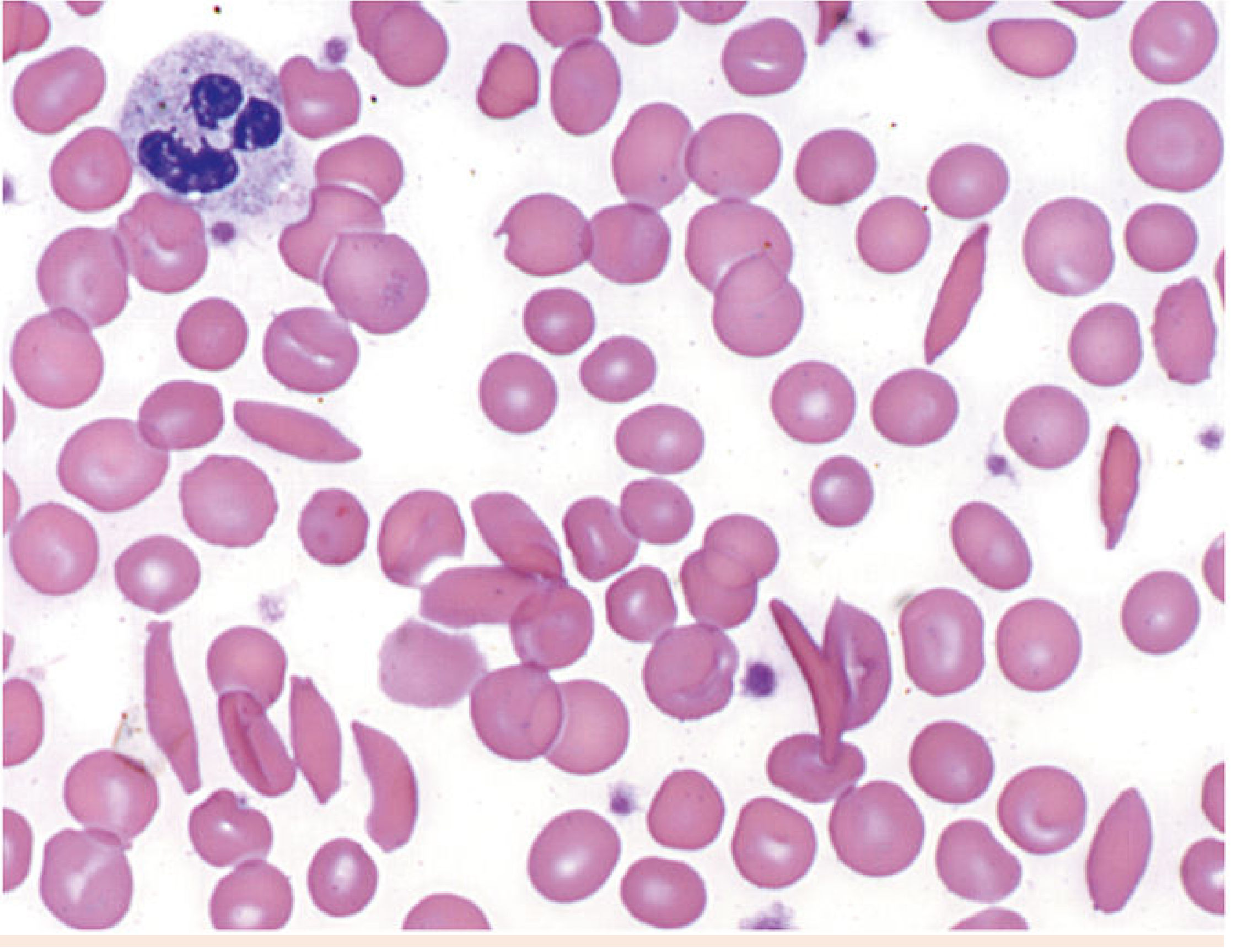 Sickle-cell anemia peripheral smear