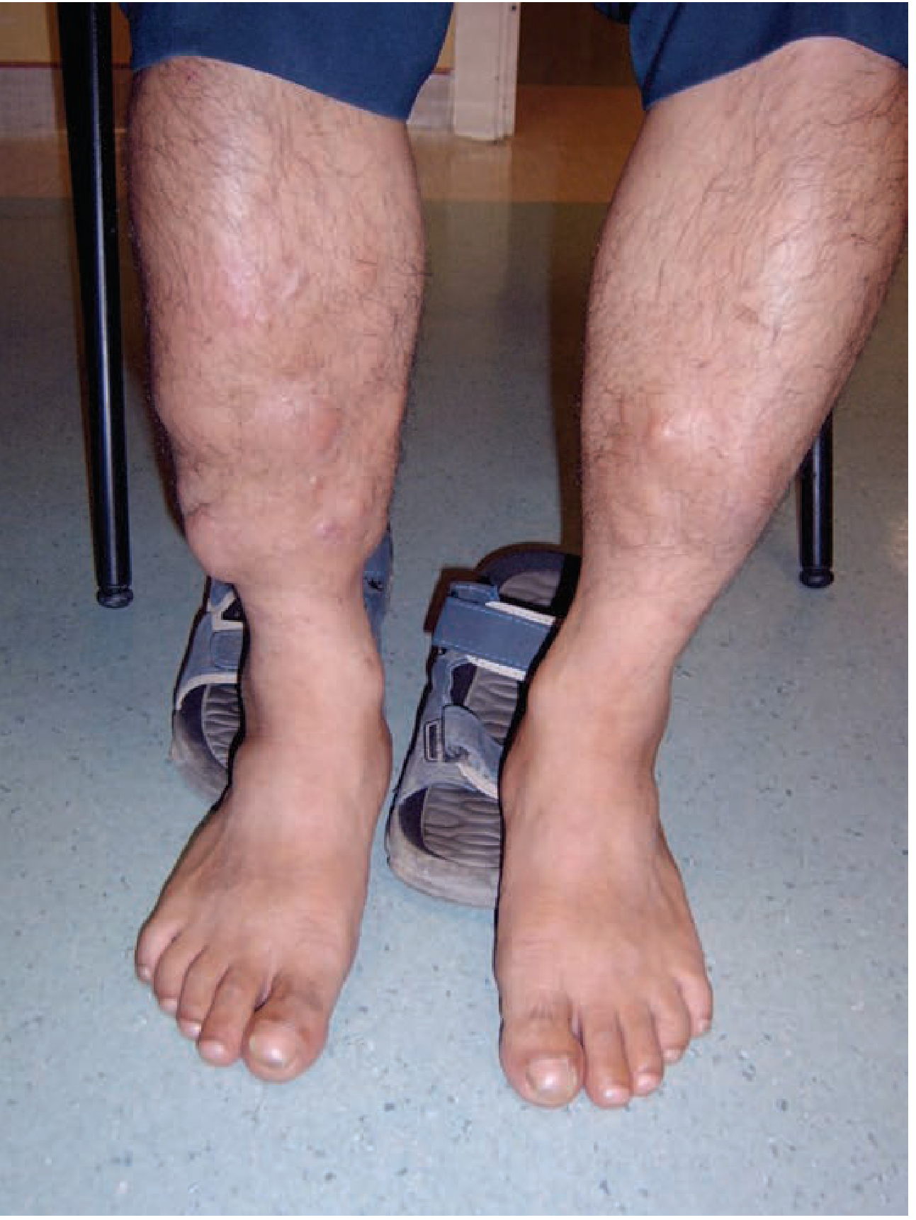 Non-pitting myxedema at ankles in hypothyroidism