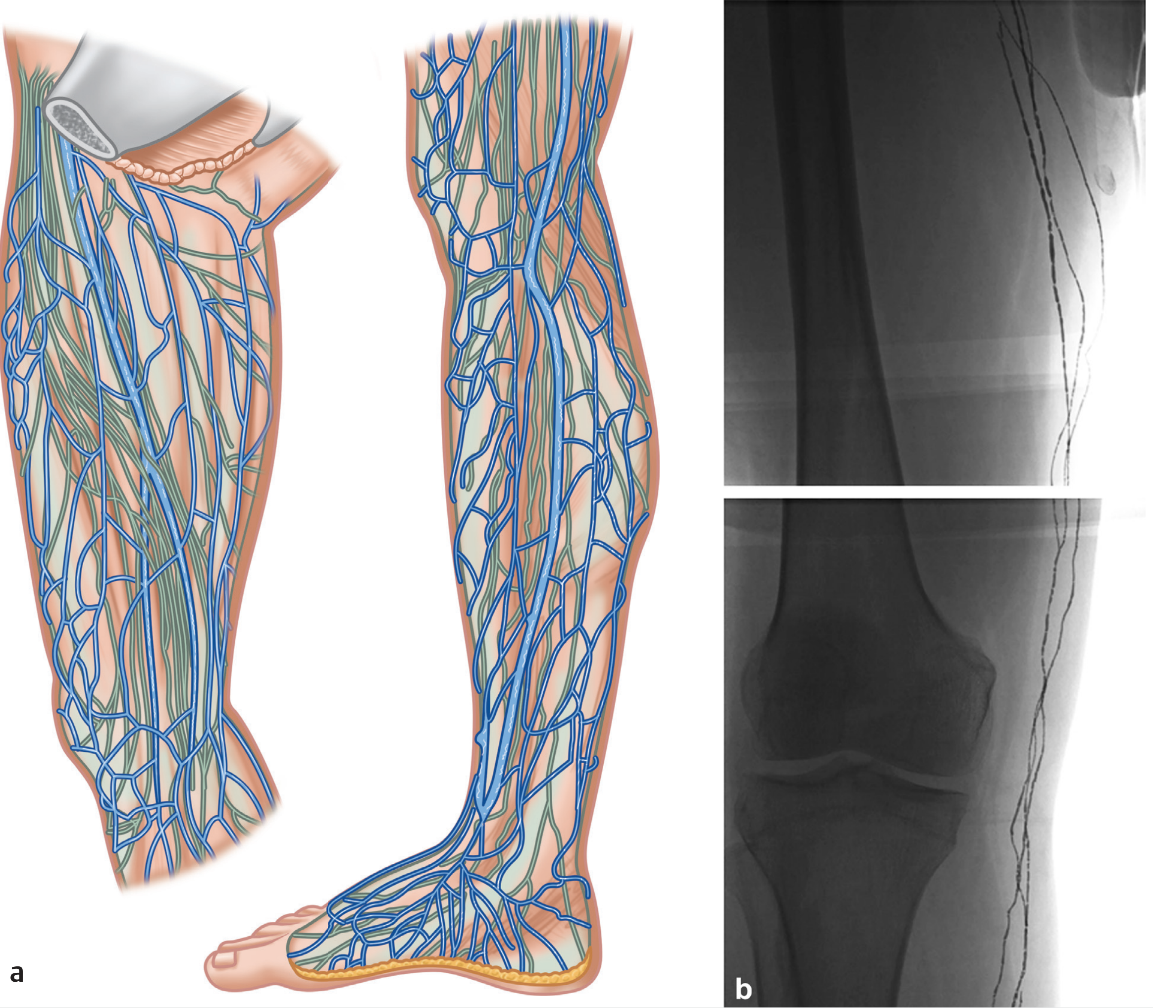 Medial group lymphatic drainage of the lower limb - illustration and lymphangiography