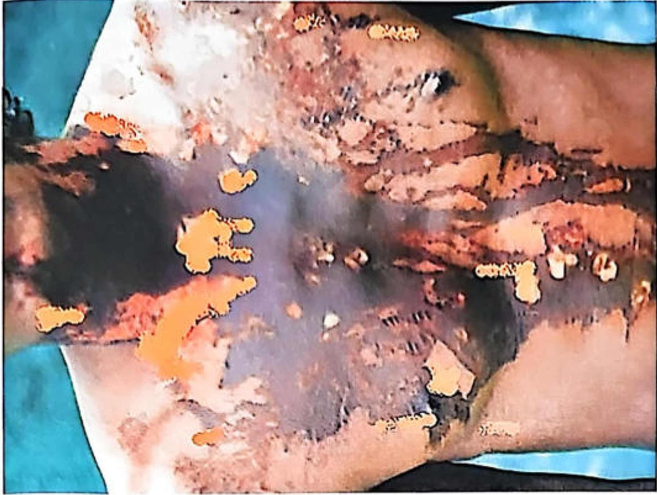 Vitriolage - acid burns on skin