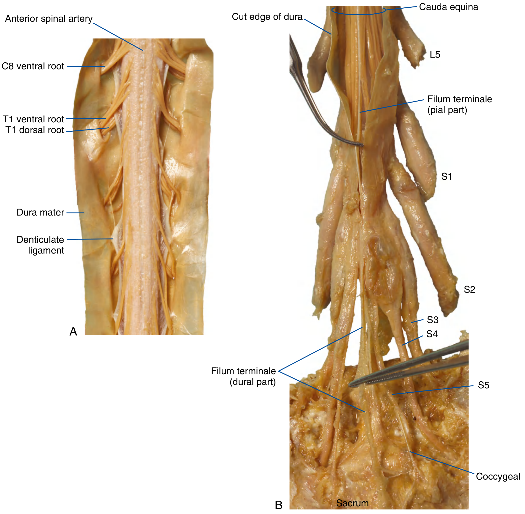 Cadaver dissection showing filum terminale - pial part running through cauda equina from conus to S2, and dural part from S2 to coccyx; also showing denticulate ligament on the left side
