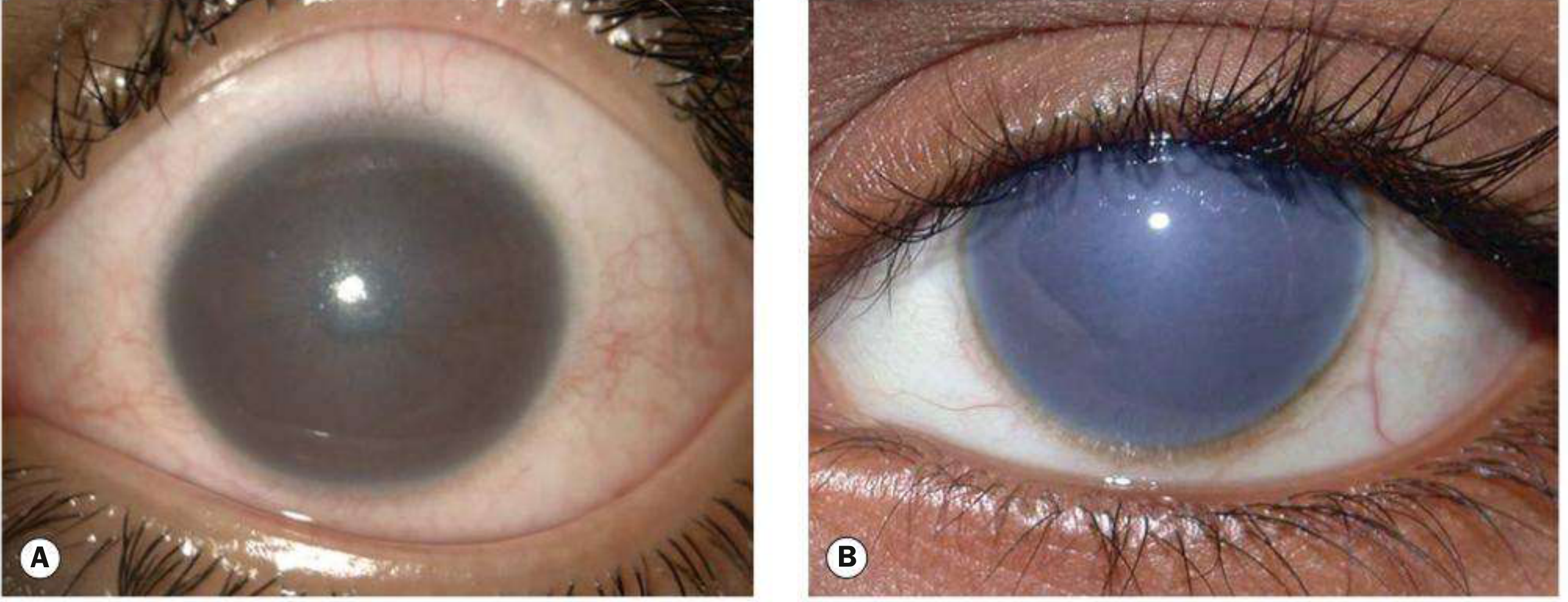 Arcus senilis - corneal lipid ring (Kanski's Clinical Ophthalmology)