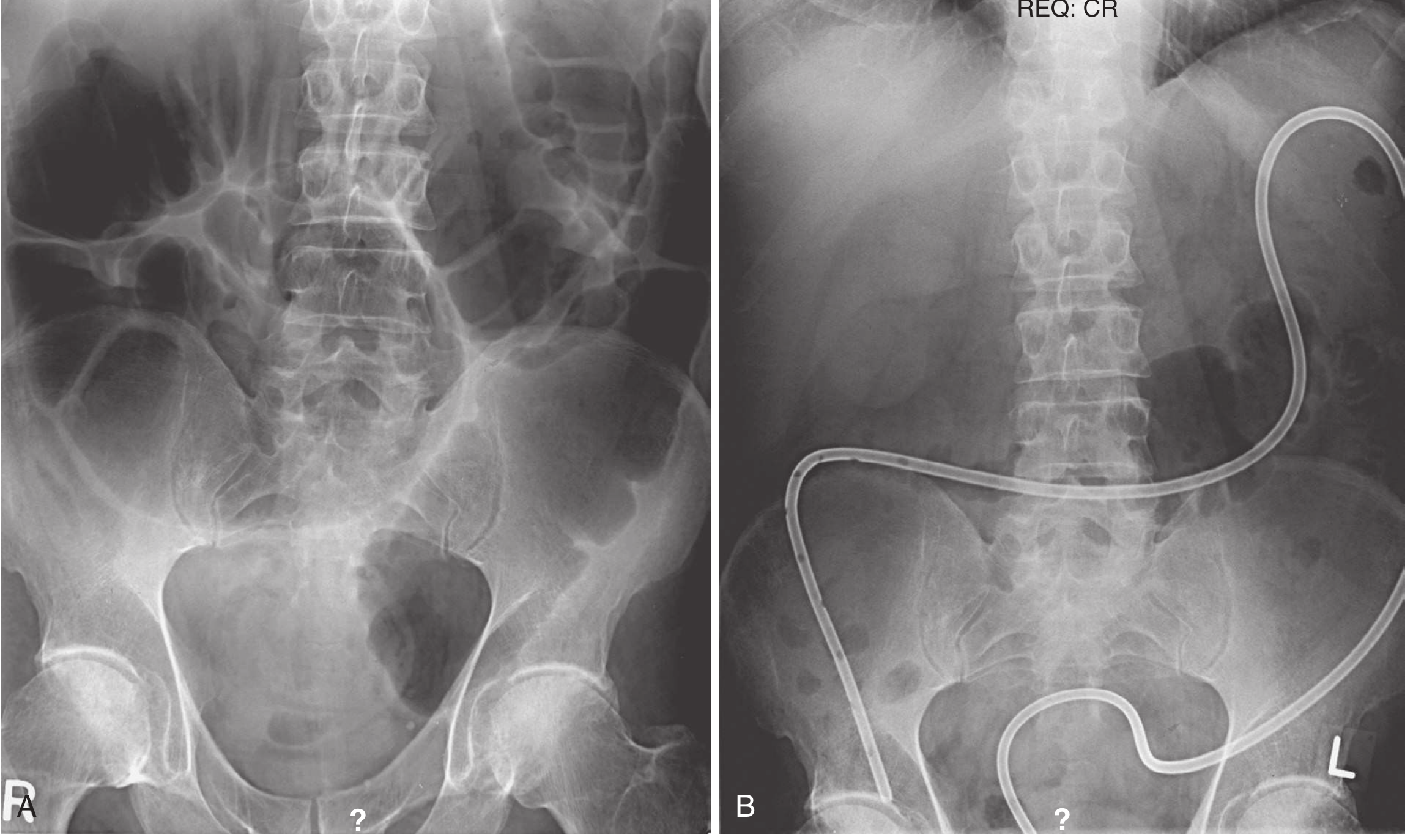 Plain abdominal radiograph before and after colonoscopic decompression tube placement showing significant reduction in colonic gas