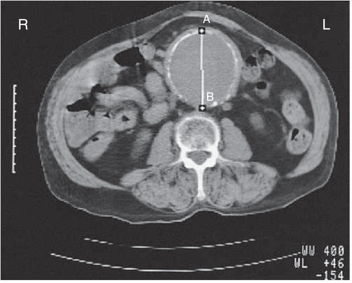 CT of infrarenal AAA with mural thrombus and measured lumen - Goldman-Cecil Medicine