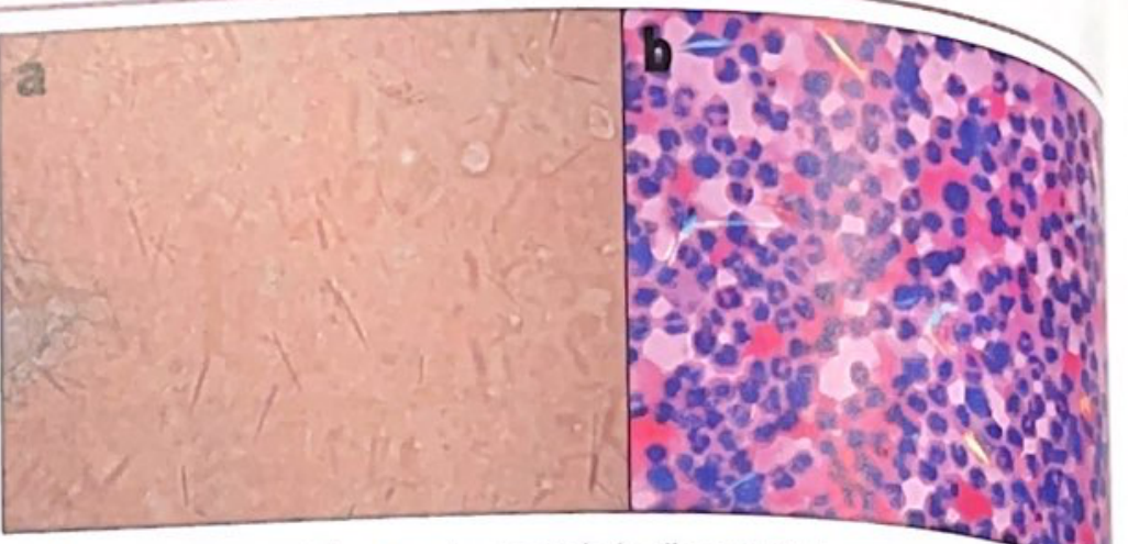 Urate crystals under direct light (left) appearing as translucent needle-shaped structures, and under polarized light (right) appearing as negatively birefringent crystals among dense neutrophils