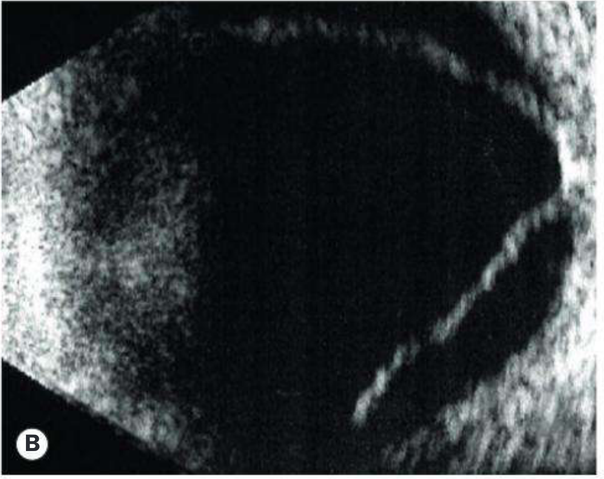 B-scan showing retinal detachment