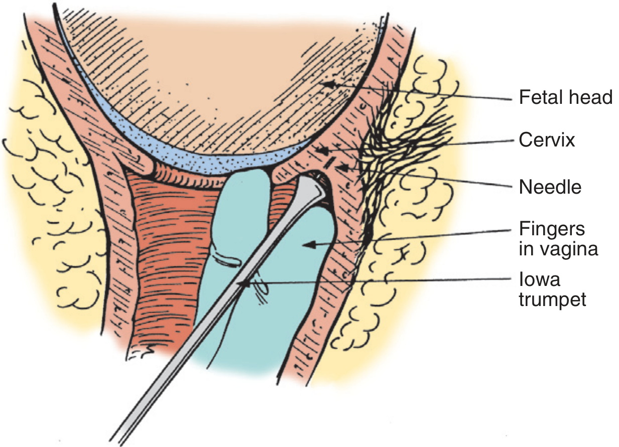 Paracervical block technique with Iowa Trumpet during labor