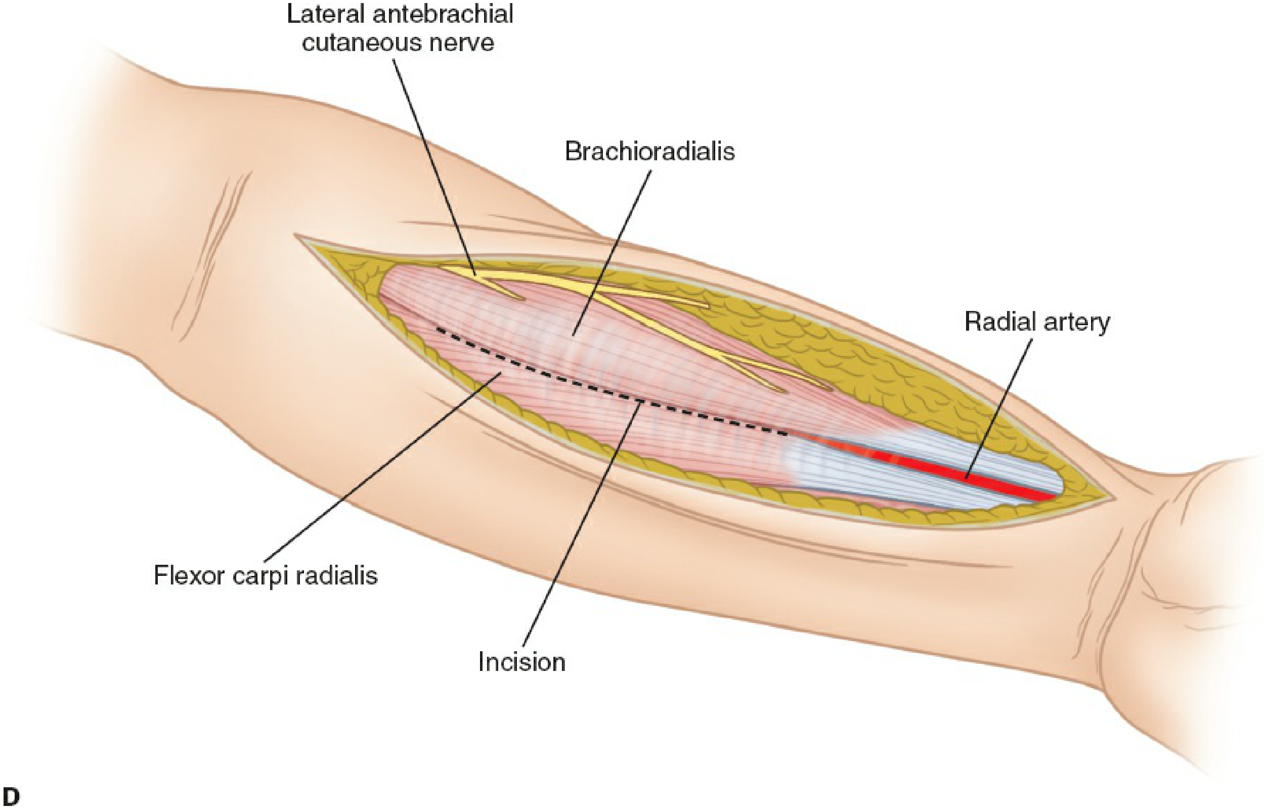 Superficial dissection showing brachioradialis laterally, flexor carpi radialis medially, lateral antebrachial cutaneous nerve, and radial artery