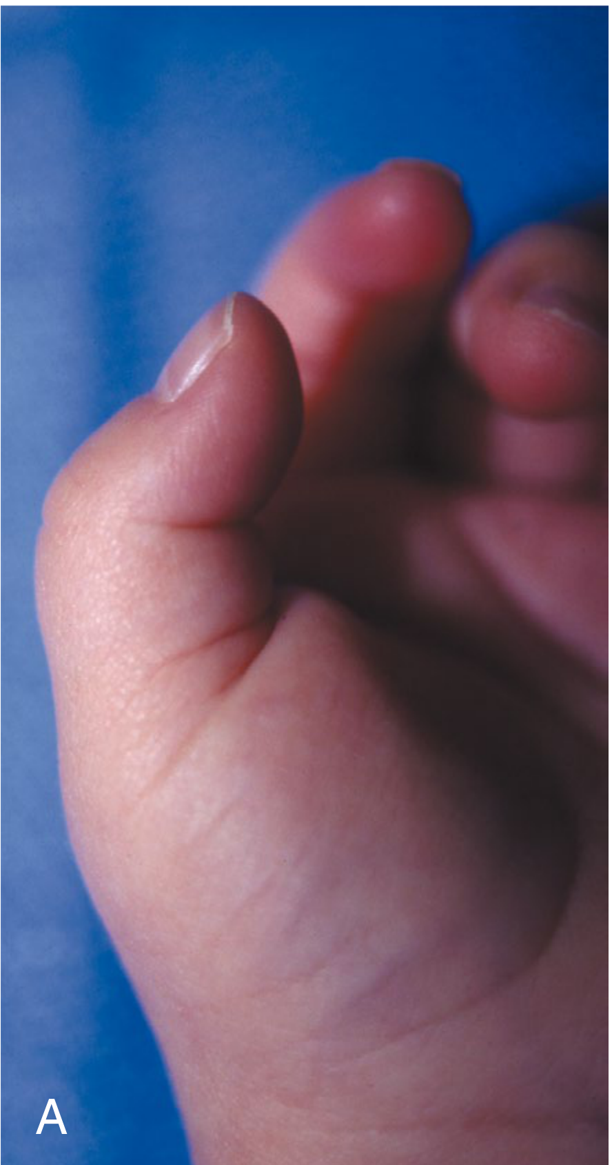 Trigger thumb in a 2-year-old child showing fixed flexion deformity at the IP joint