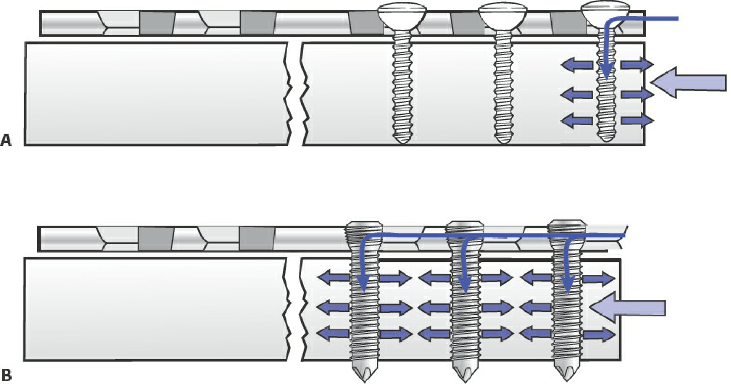 Conventional vs. locked plate load distribution - Rockwood and Green's, 2025