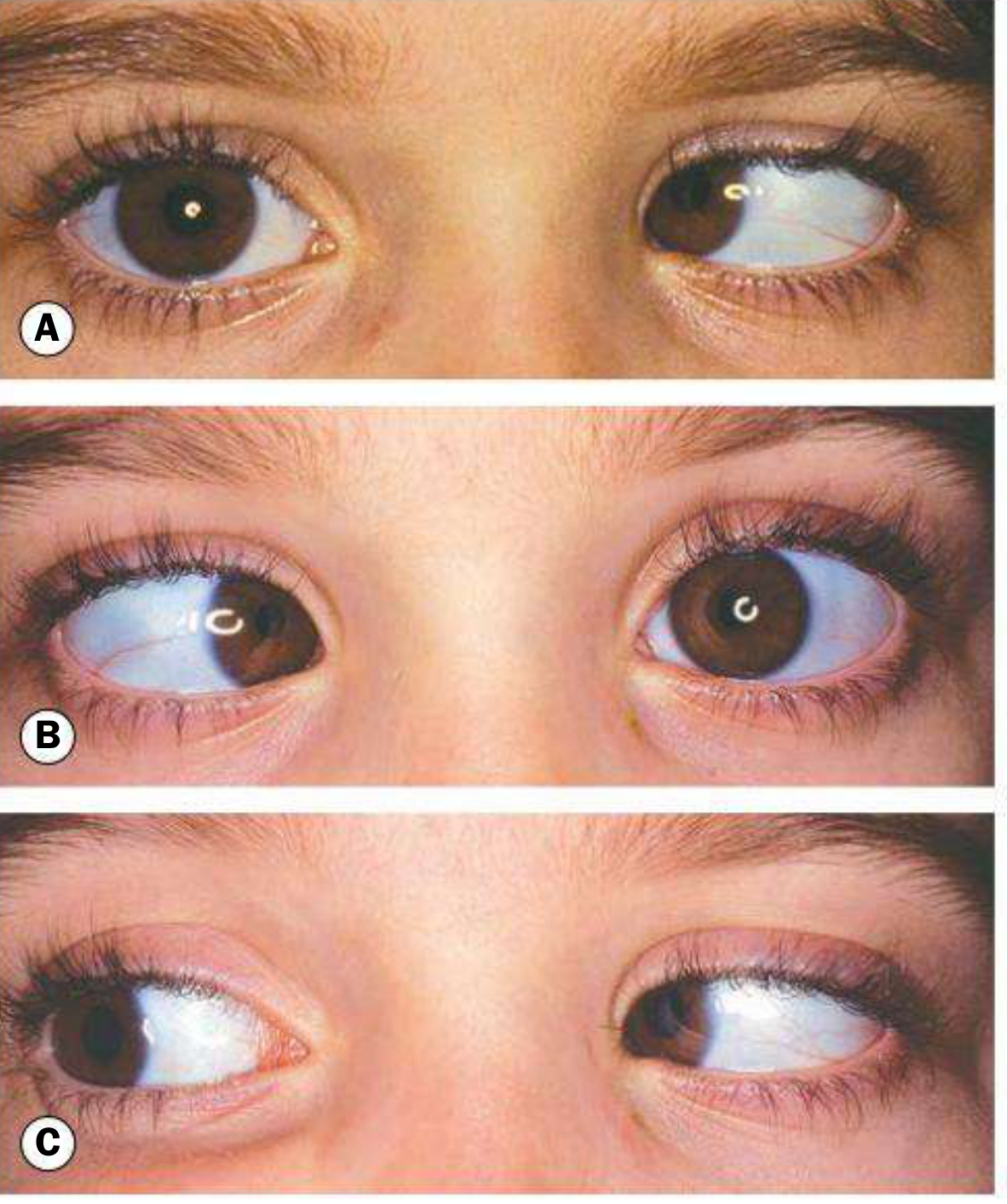 Acute left sixth nerve palsy in a child showing: (A) esotropia in primary position, (B) marked limitation of abduction, (C) normal adduction - Kanski's Clinical Ophthalmology
