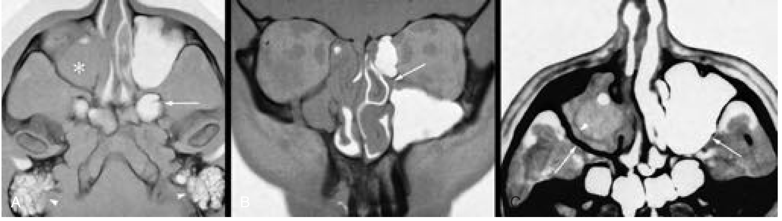 Chronic sinusitis CT — axial/coronal/contrast