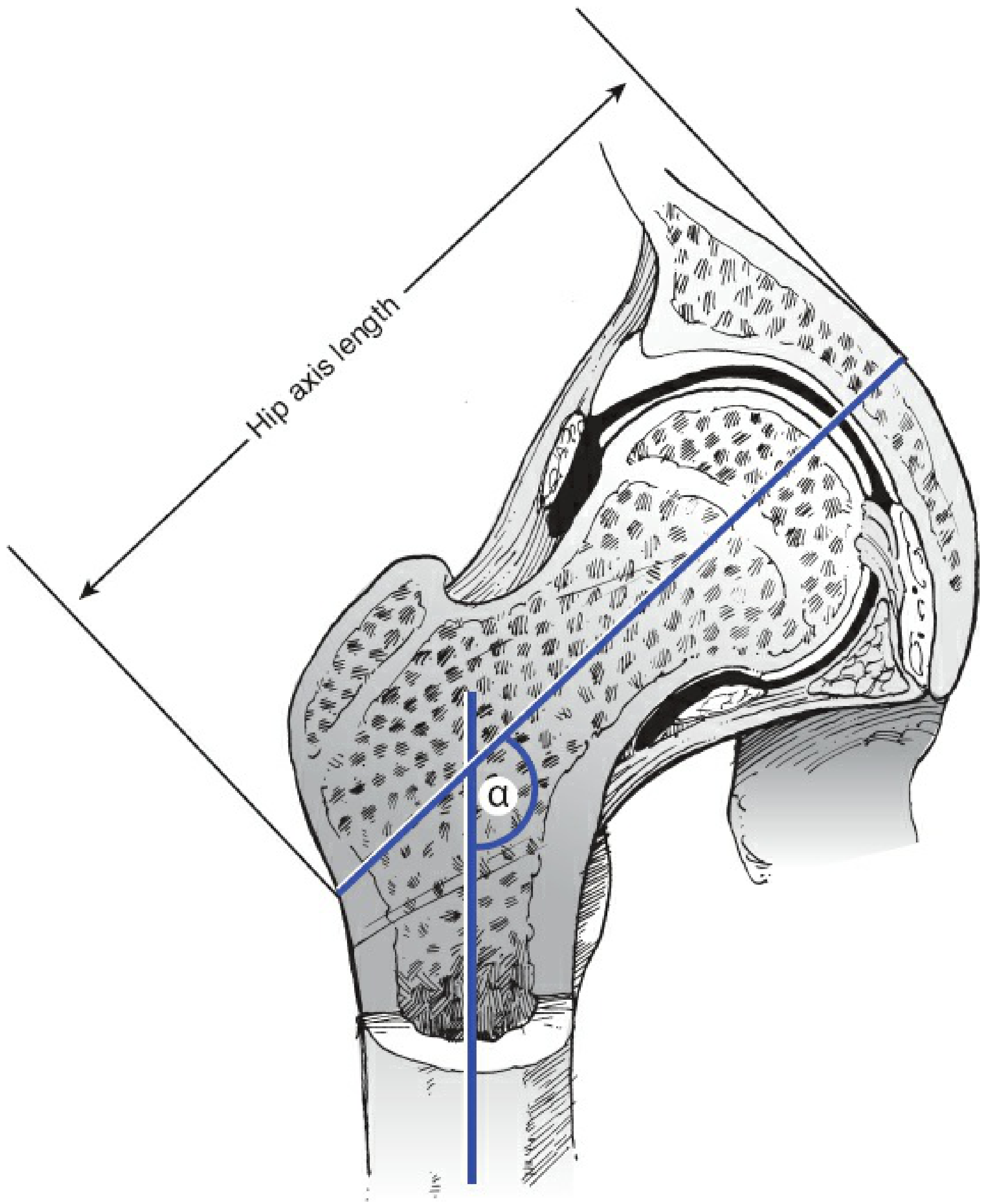 Hip axis length and neck-shaft angle diagram