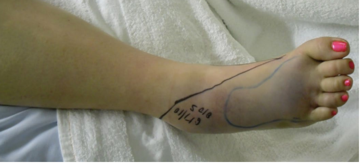Serial skin marking of snakebite envenomation