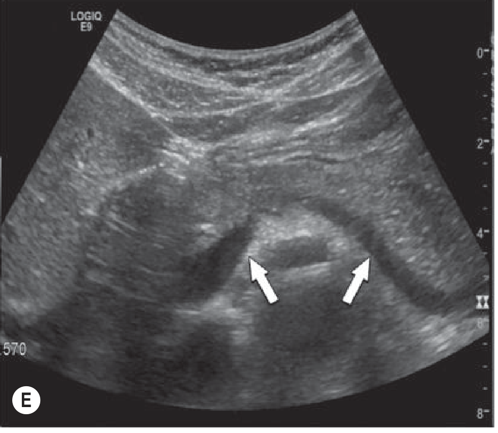 Normal pancreatic body and tail - US panel E