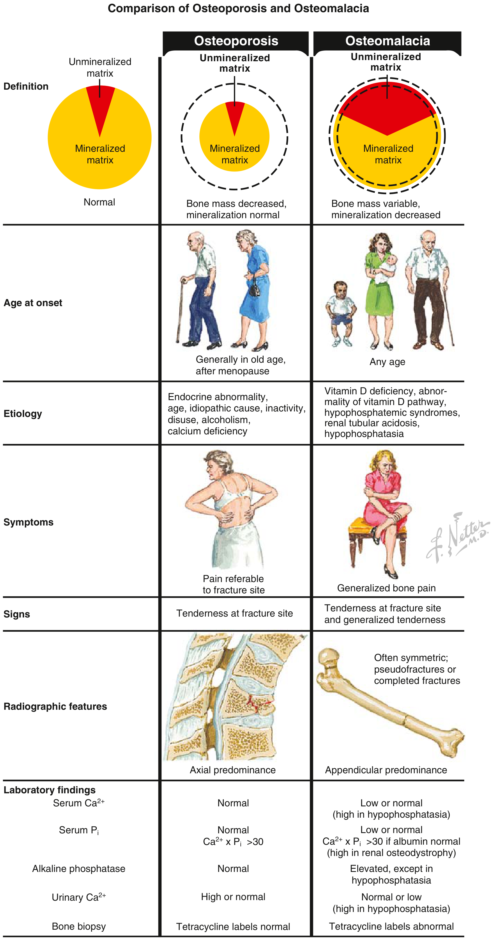 Comparison of osteoporosis and osteomalacia - Netter diagram