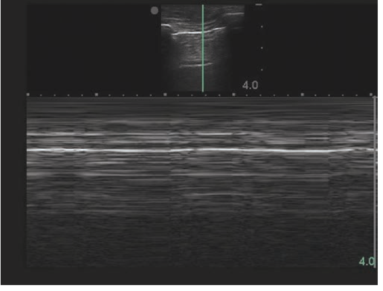 Pneumothorax M-mode "stratosphere/barcode sign": horizontal lines throughout